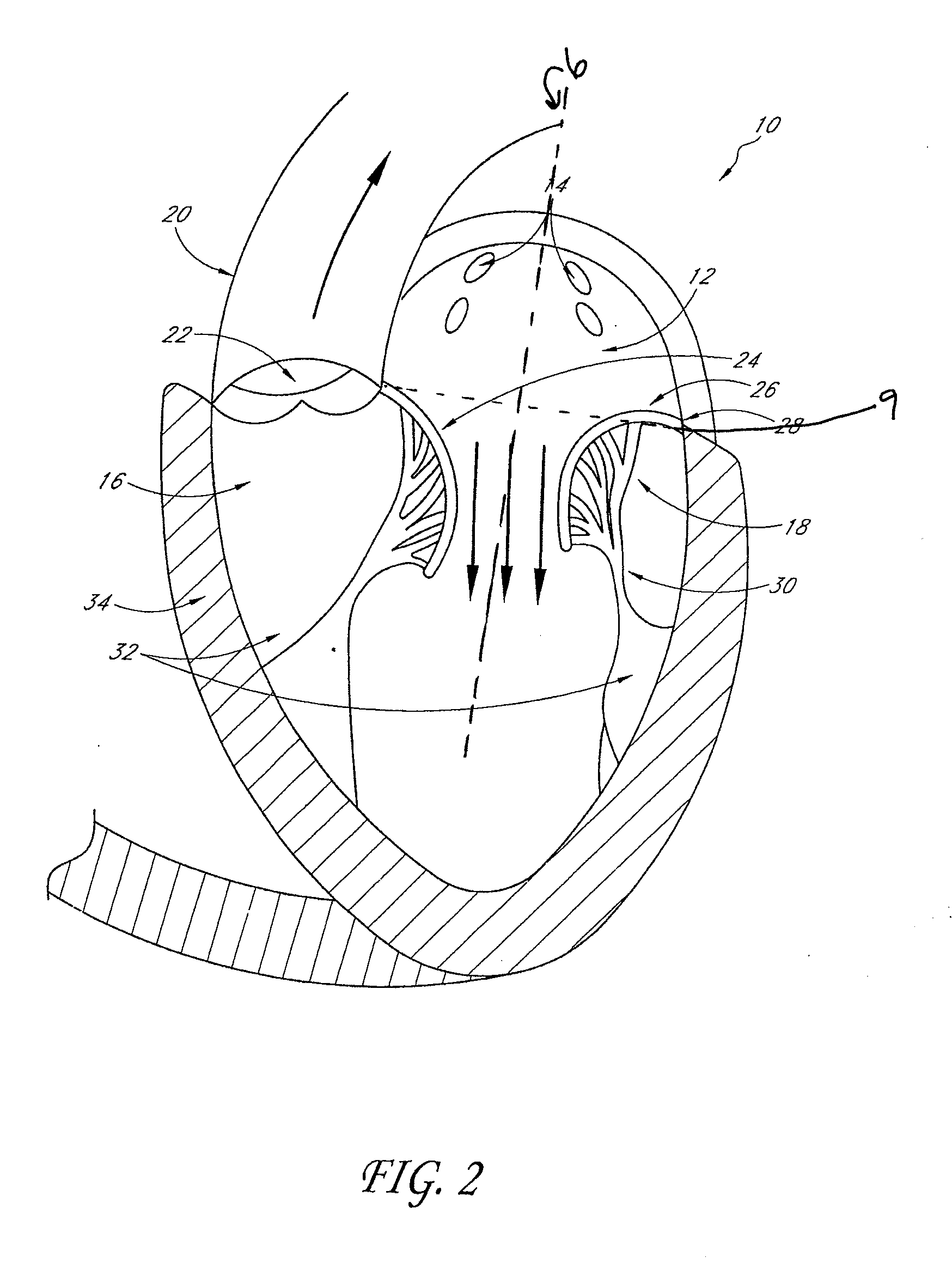 Transvalvular intraannular band for aortic valve repair