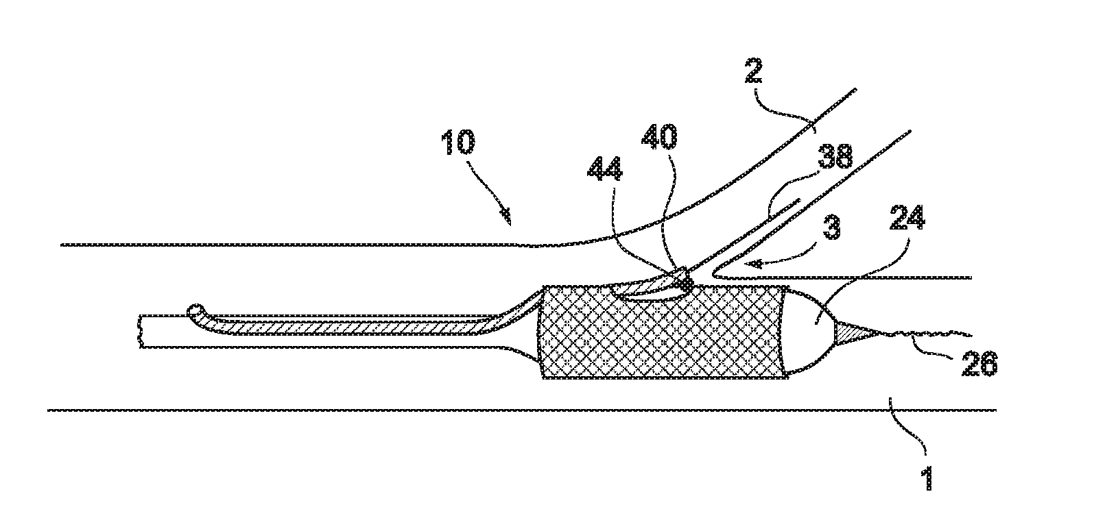 Vessel treatment devices