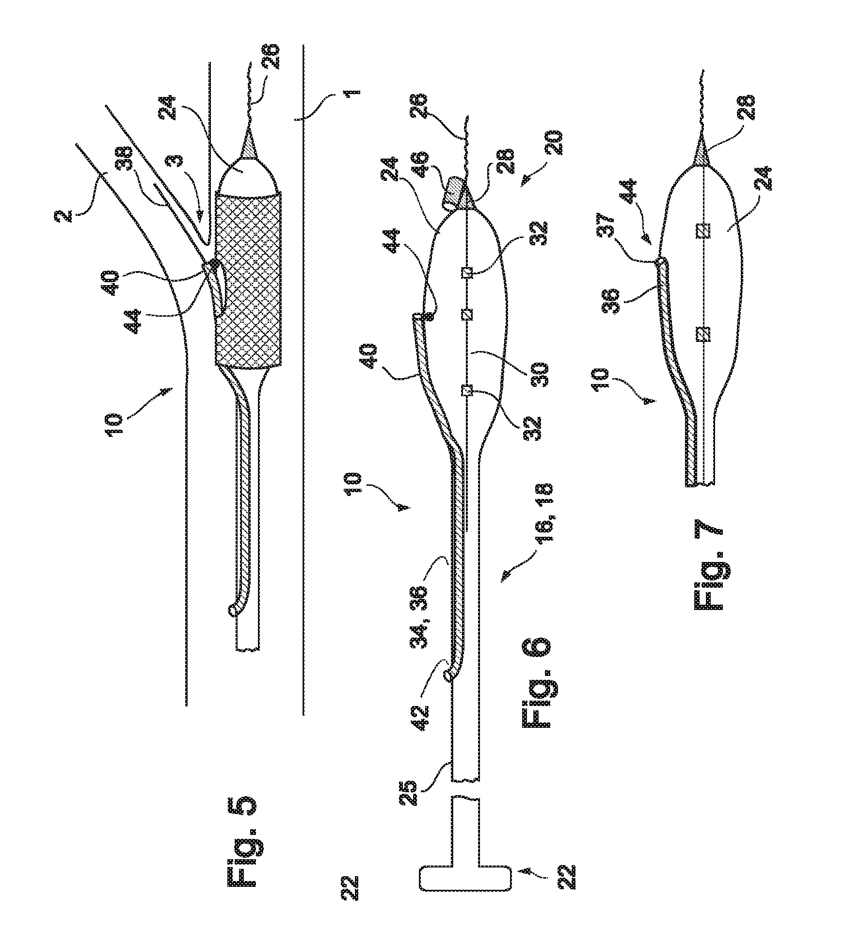 Vessel treatment devices