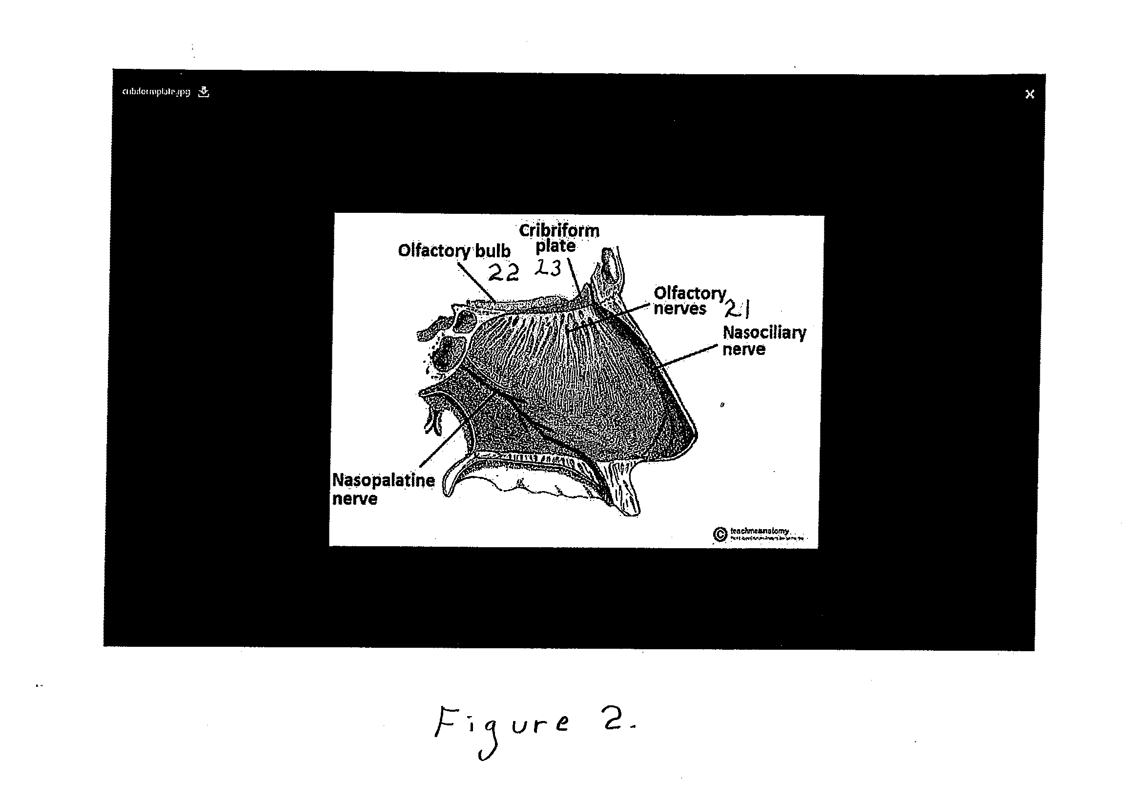 Formulation, apparatus, and methods for treatment of brain trauma