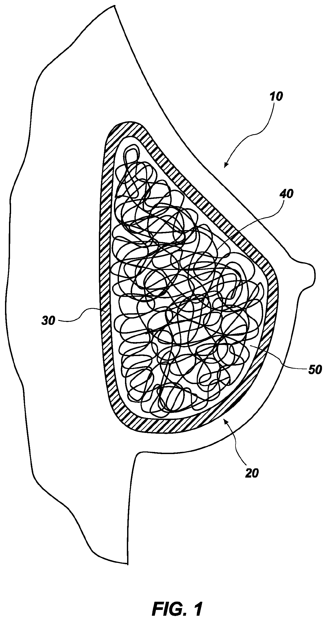 Prosthesis