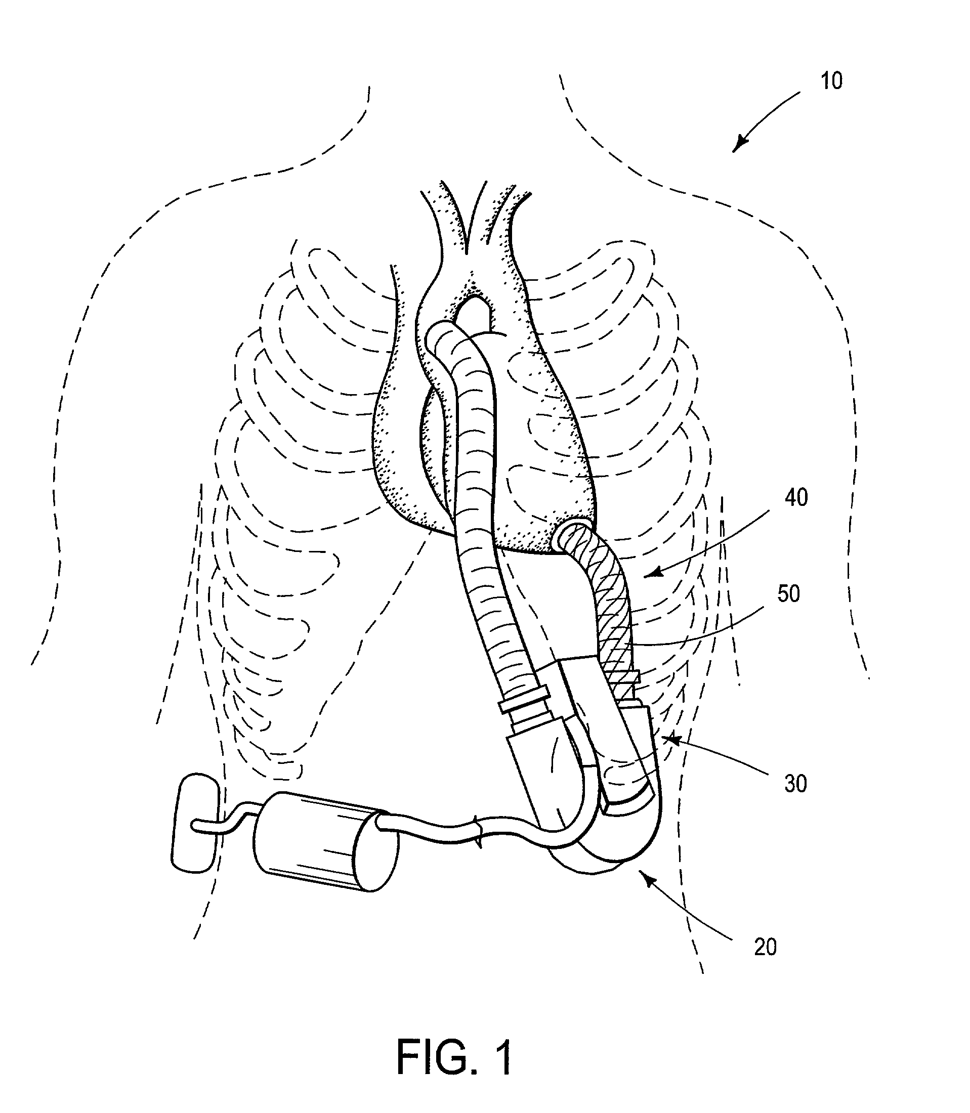 Non-porous smooth ventricular assist device conduit