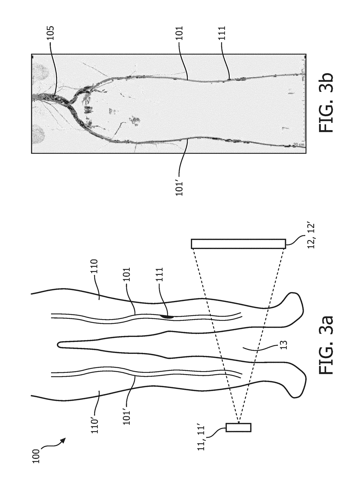 Stenosis assessment