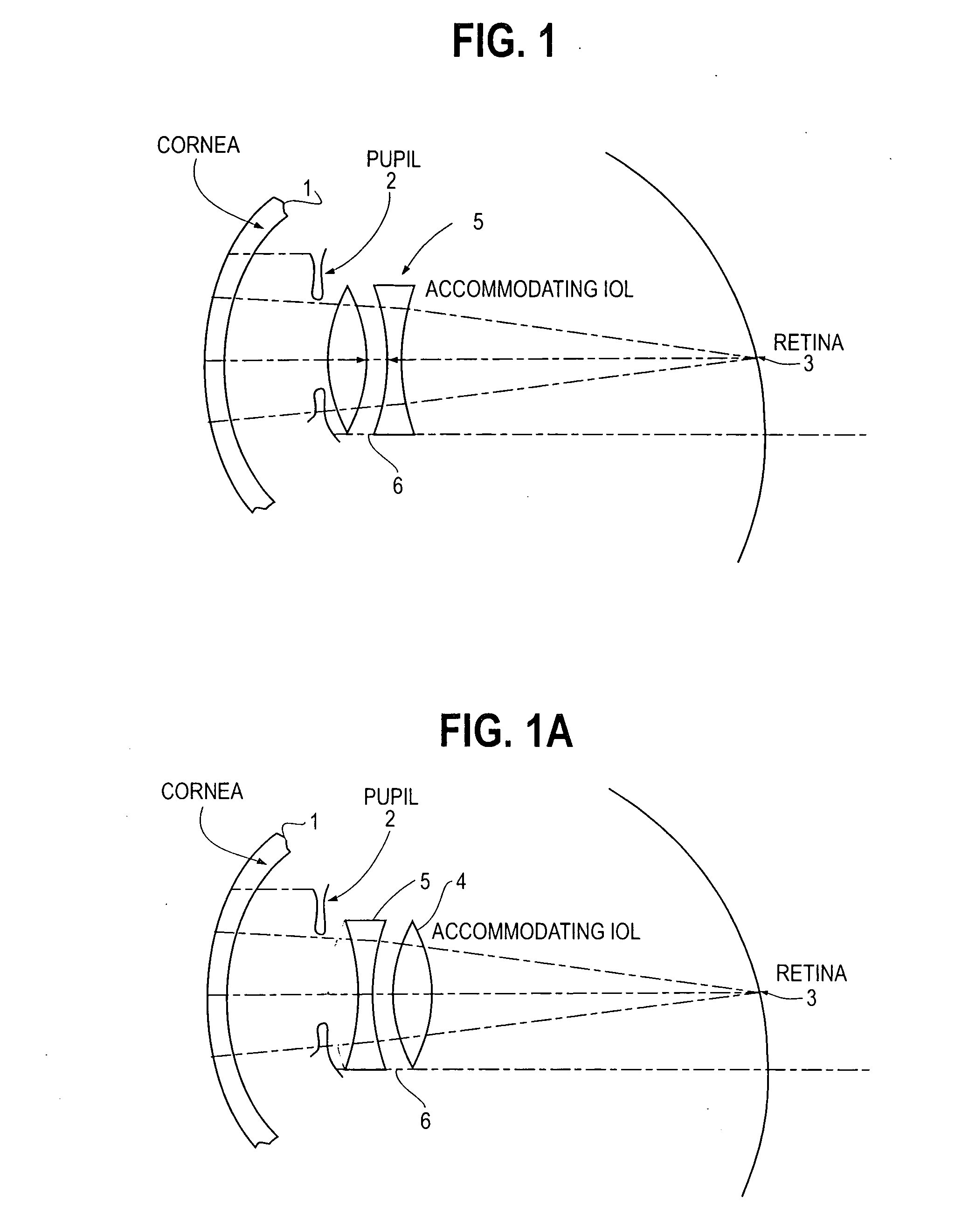 Accommodating intraocular lens