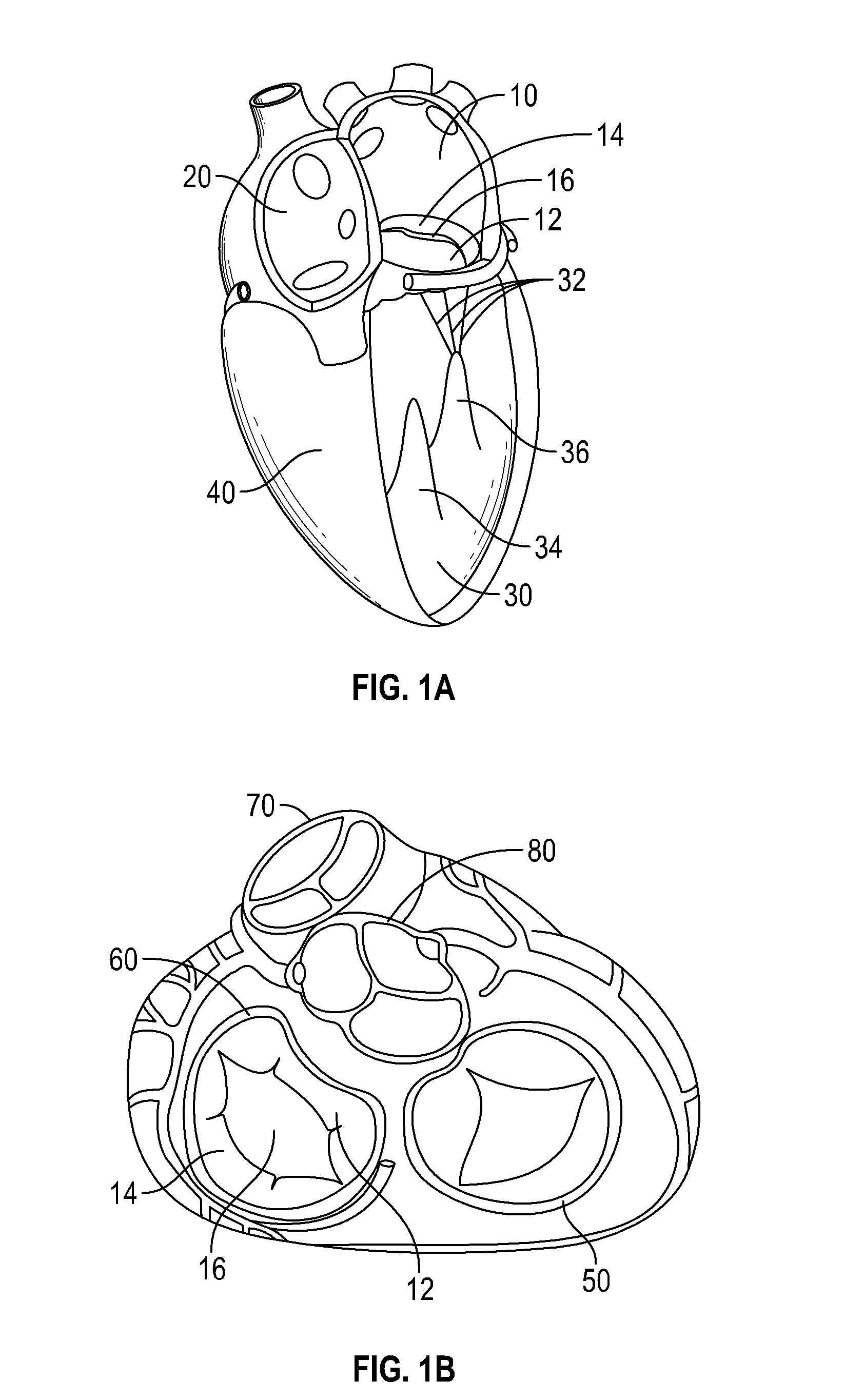 Mitral valve implants for the treatment of valvular regurgitation