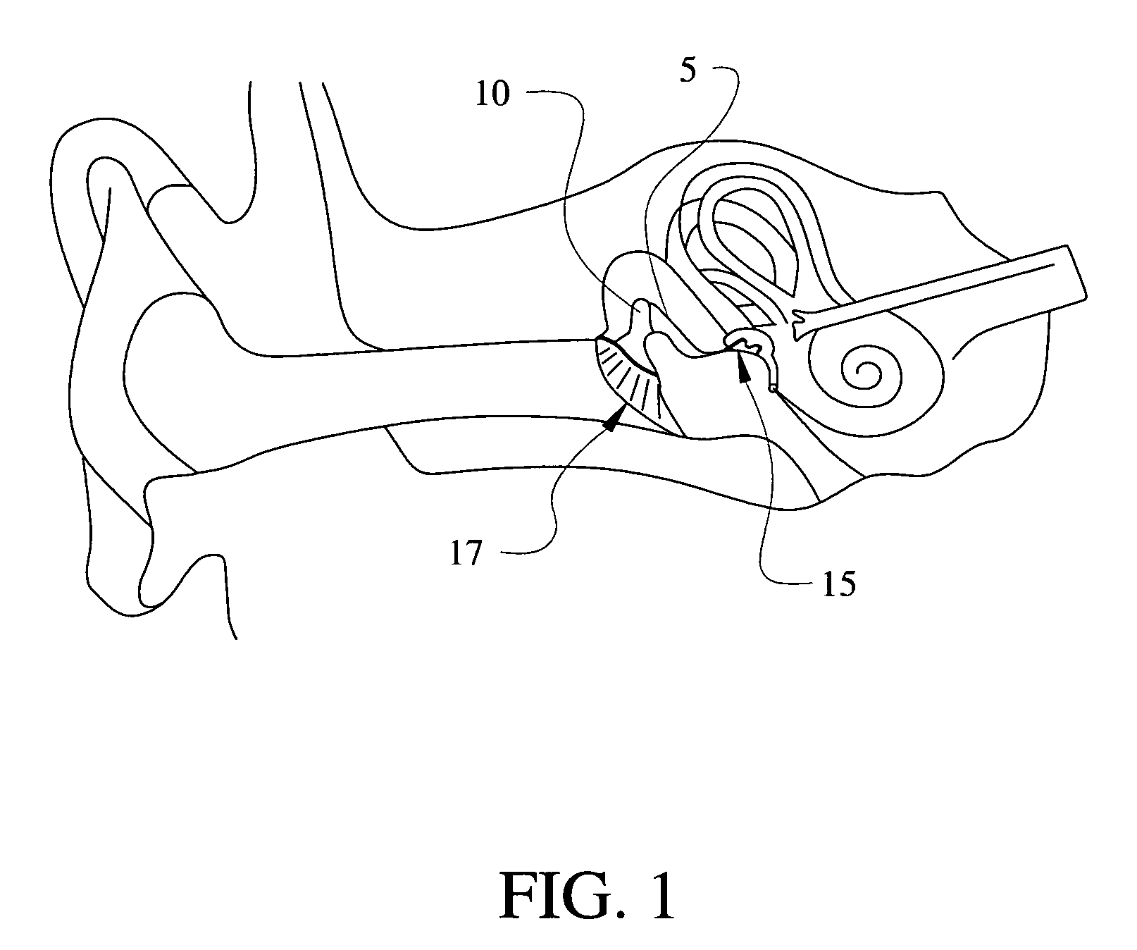 Incus replacement prosthesis