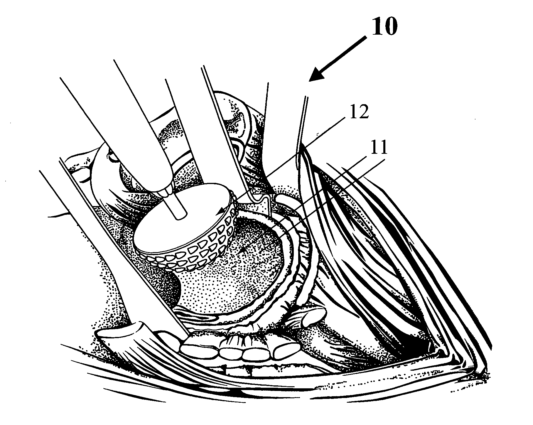 Disposable reamer shaft or modular spherical or tapered hollow reamer assembly for medical applications