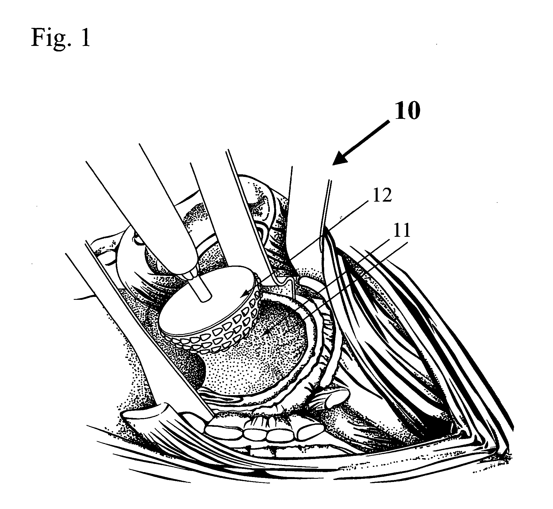 Disposable reamer shaft or modular spherical or tapered hollow reamer assembly for medical applications