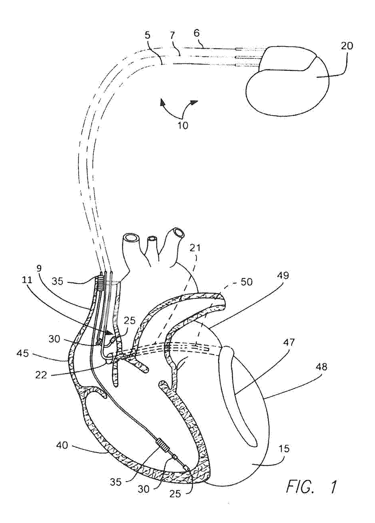 Coronary sinus- anchored sheath for delivery of his bundle pacing lead