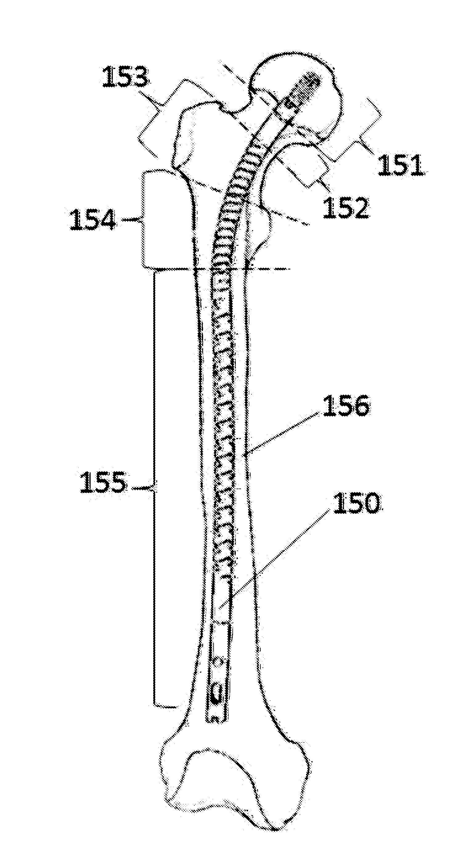 Flexible Intramedullary Nail