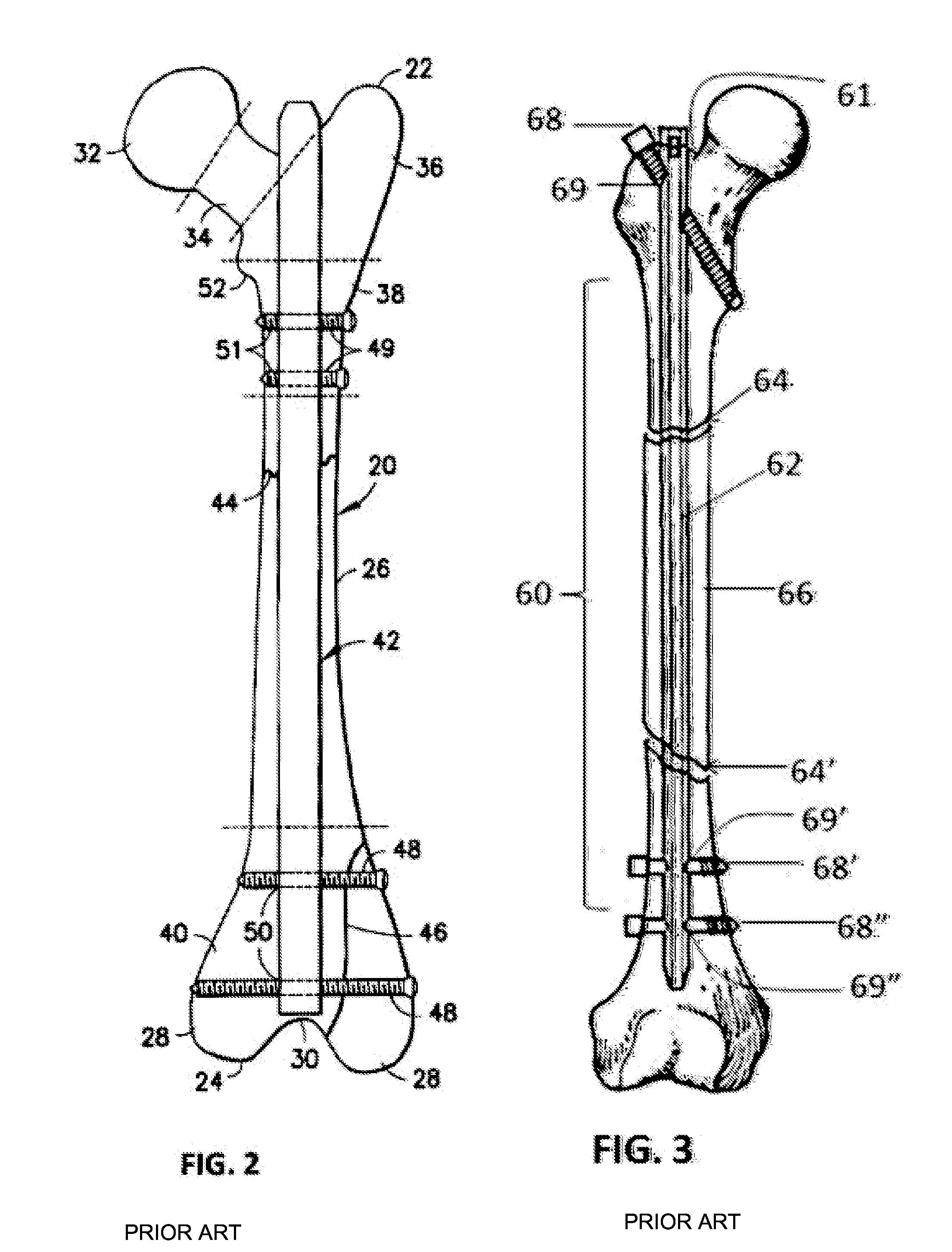 Flexible Intramedullary Nail