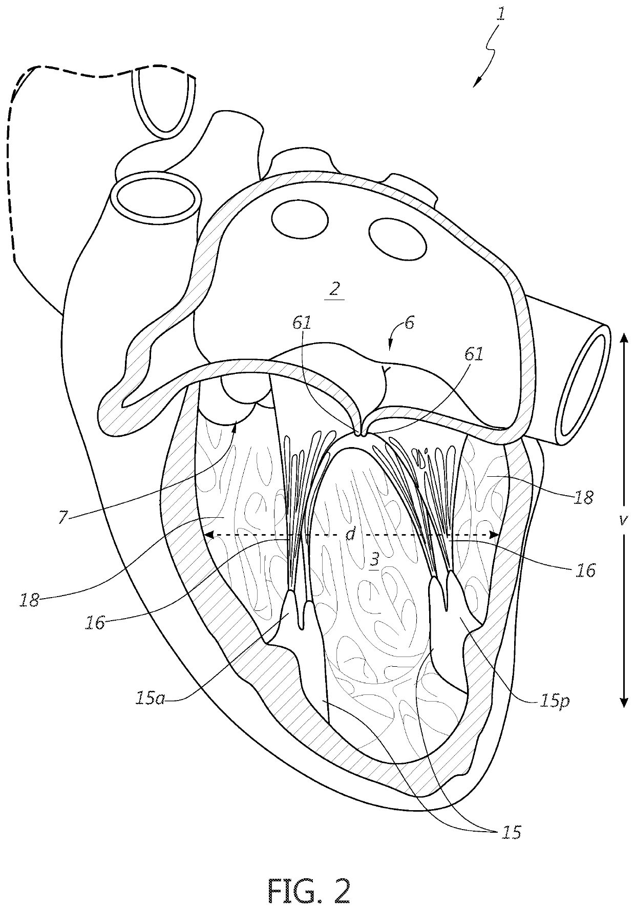 Ventricular remodeling using coil devices