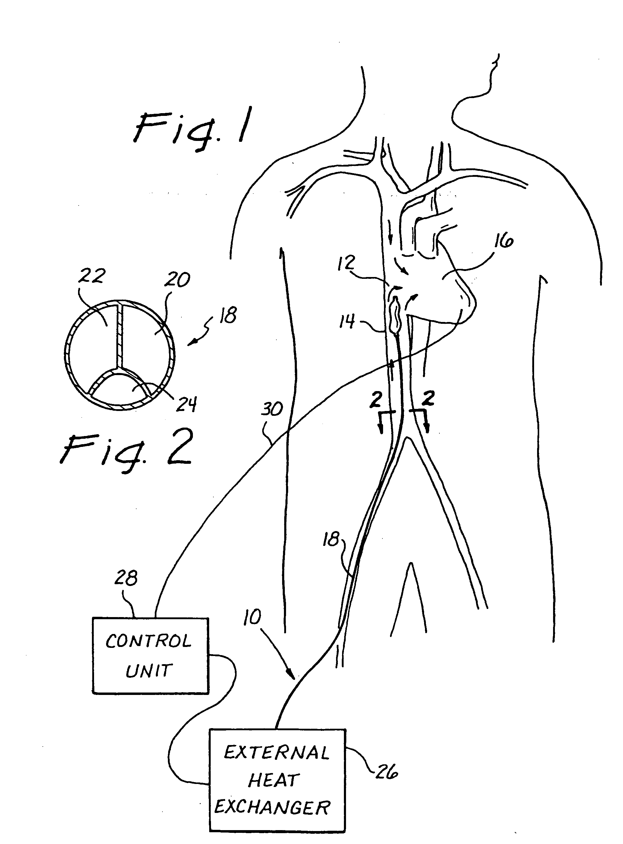 Method for reducing myocardial infarct by application of intravascular hypothermia