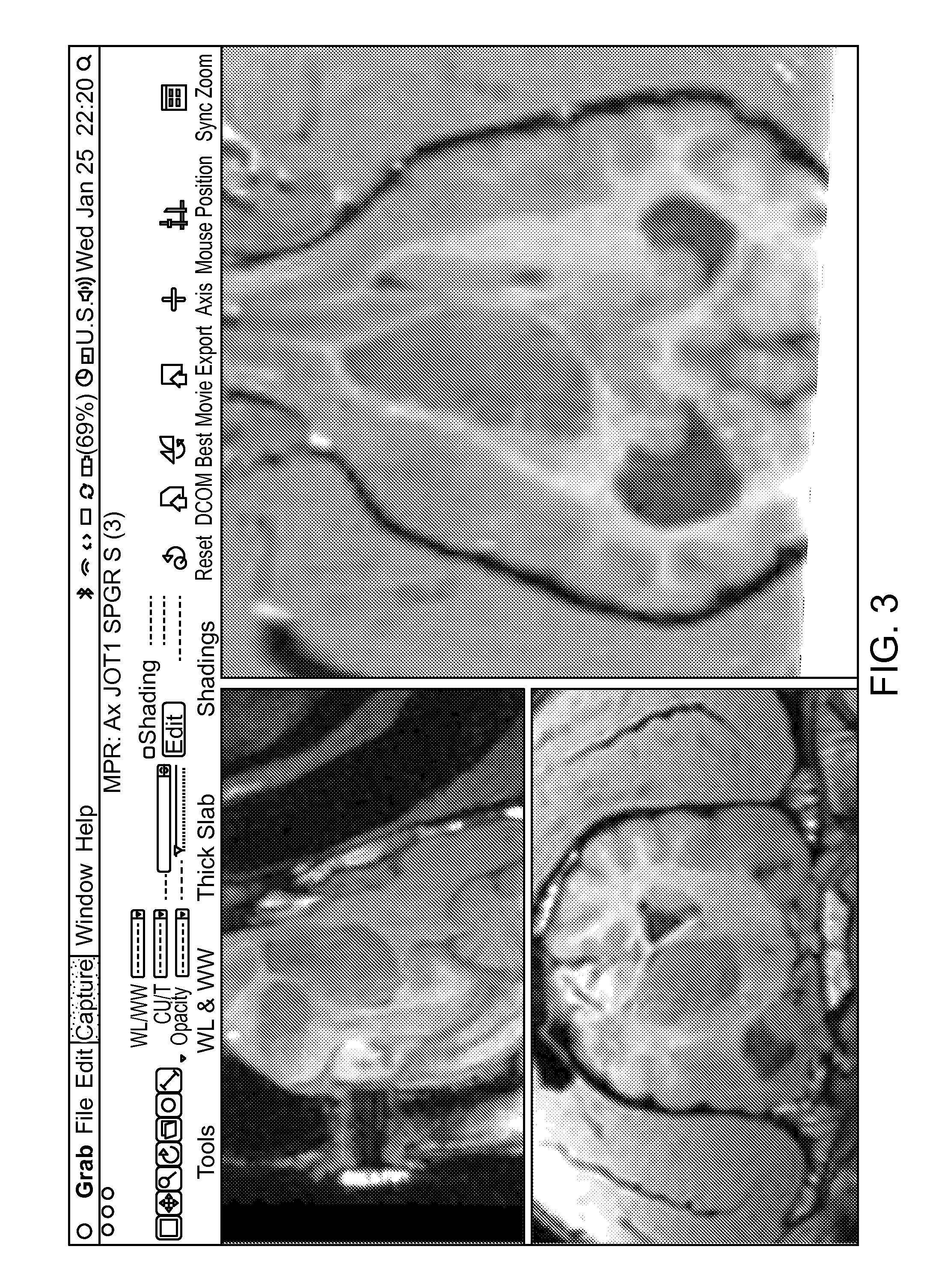 Treating Tumors of the Central Nervous System