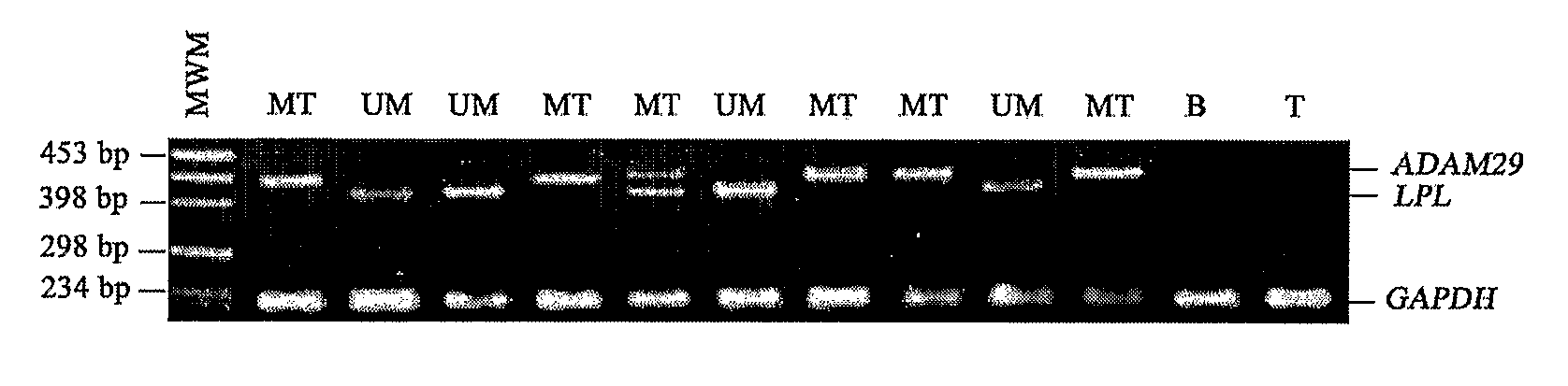 Method of Diagnosis/Prognosis of Human Chronic Lymphocytic Leukemia Comprising the Profiling of Lpl/Adam Genes