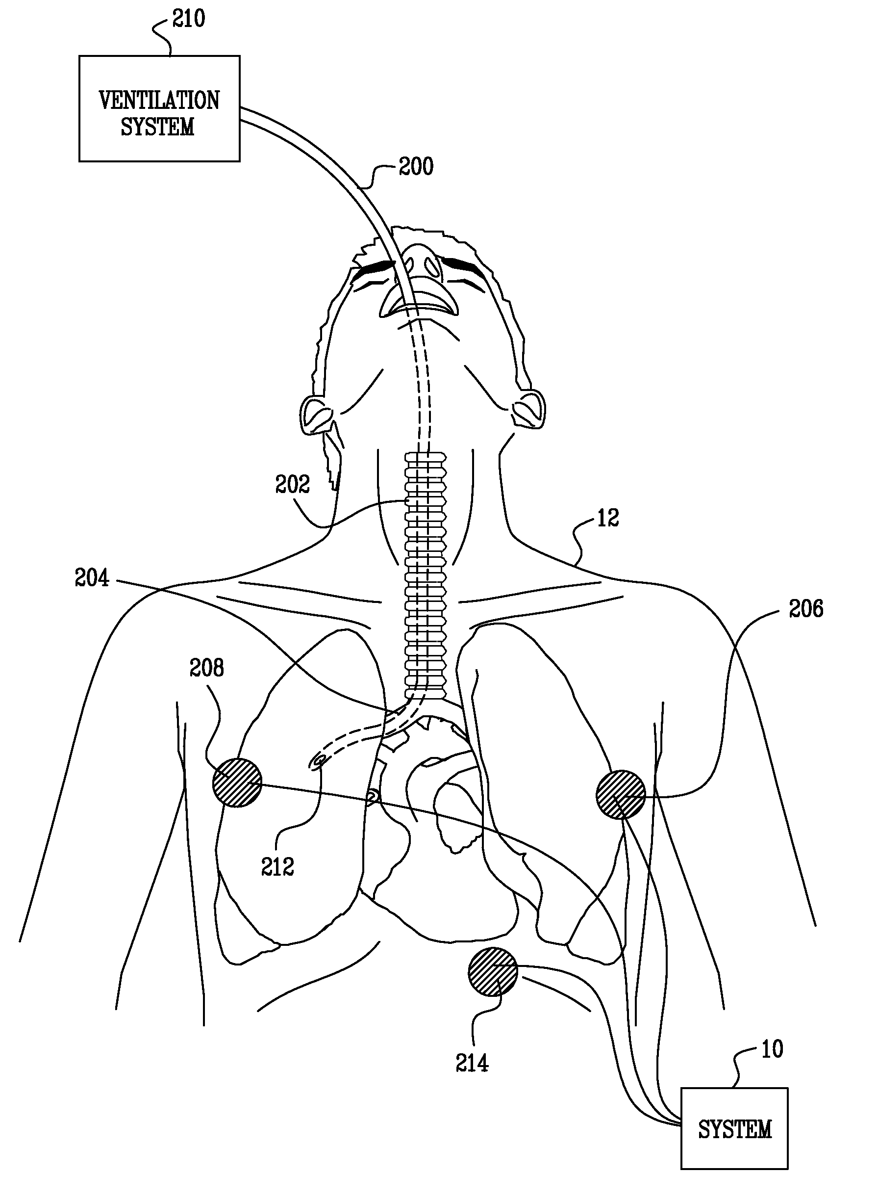 Monitoring endotracheal intubation