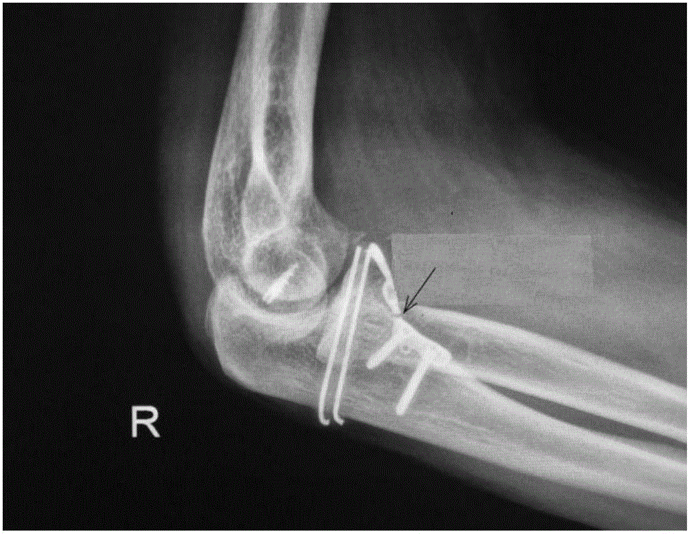 Ulna coracoid process anatomical locking plate