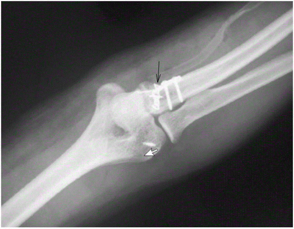 Ulna coracoid process anatomical locking plate