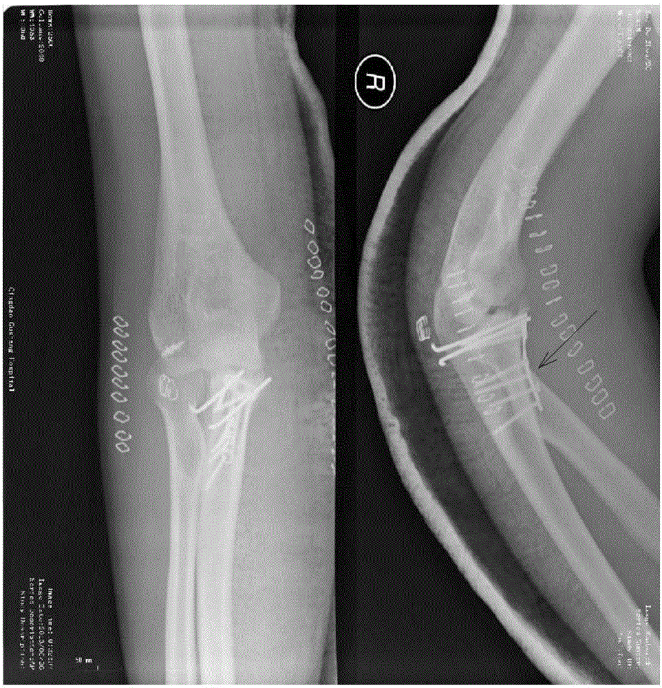 Ulna coracoid process anatomical locking plate