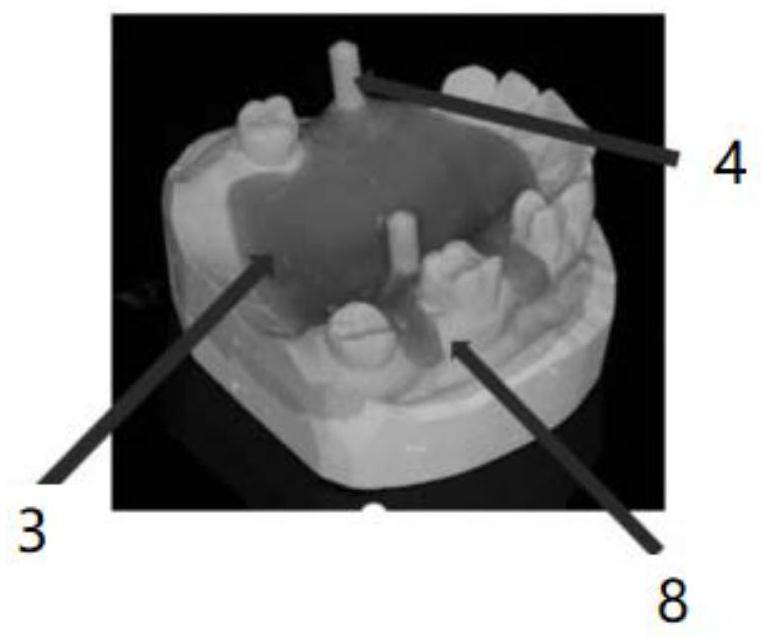 A digital transfer method and system for removable partial dentures in place