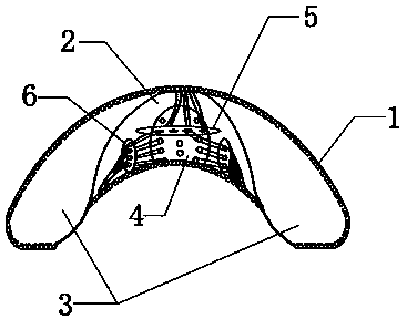 a breast augmentation prosthesis