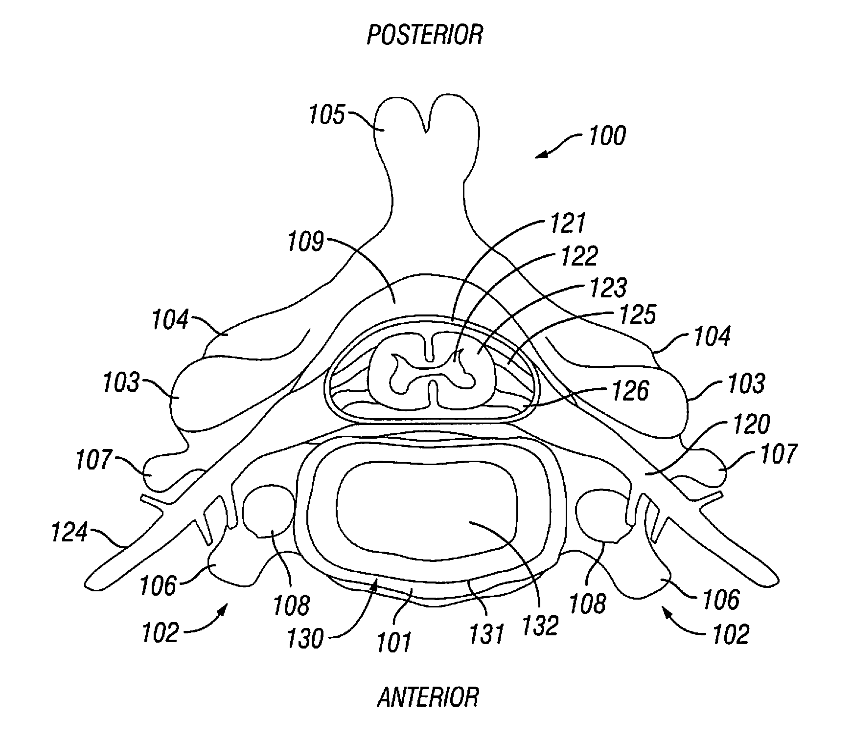 Expandable Intervertebral Spacer and Method of Posterior Insertion Thereof