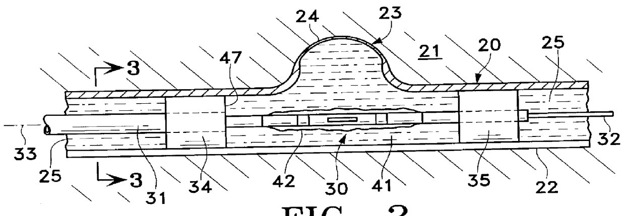 Apparatus for treating aneurysms with a thermal source