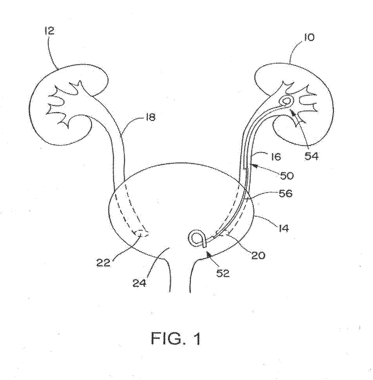 Ureteral stent for placement in a kidney and bladder