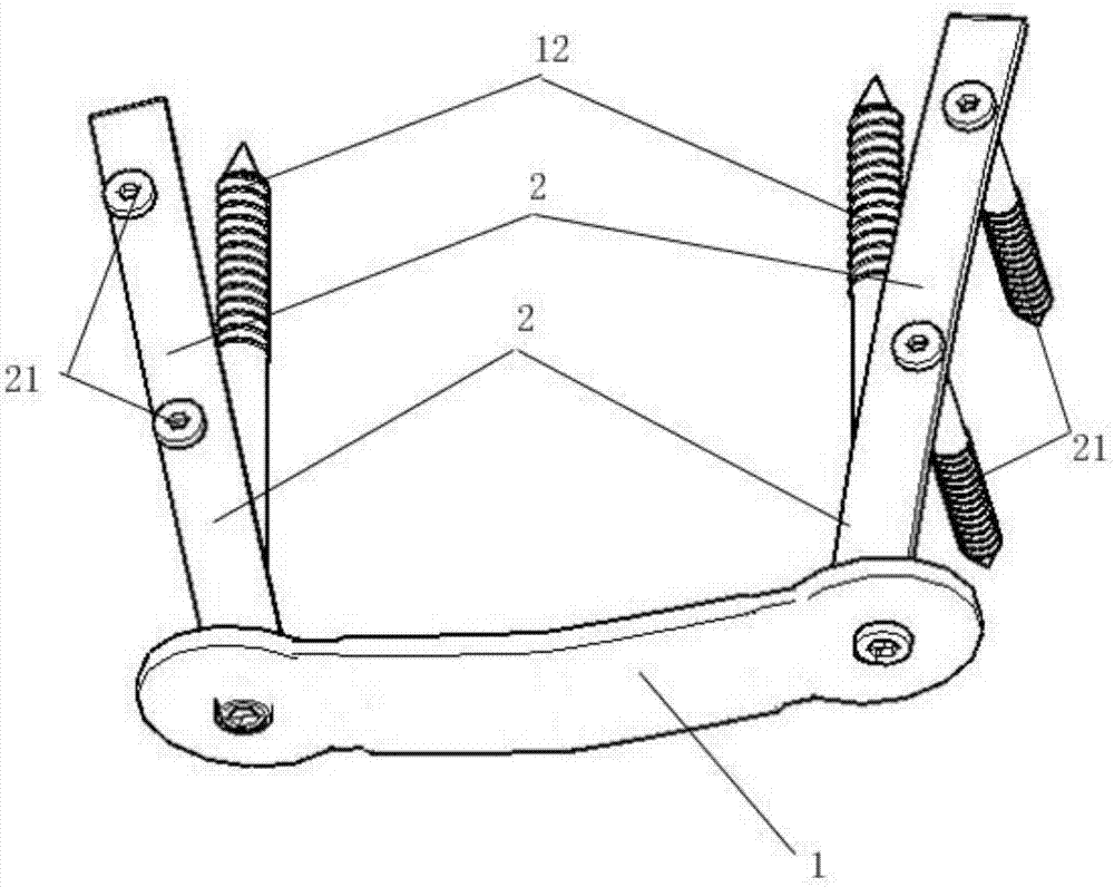 A tension bend steel plate used for patella fracture