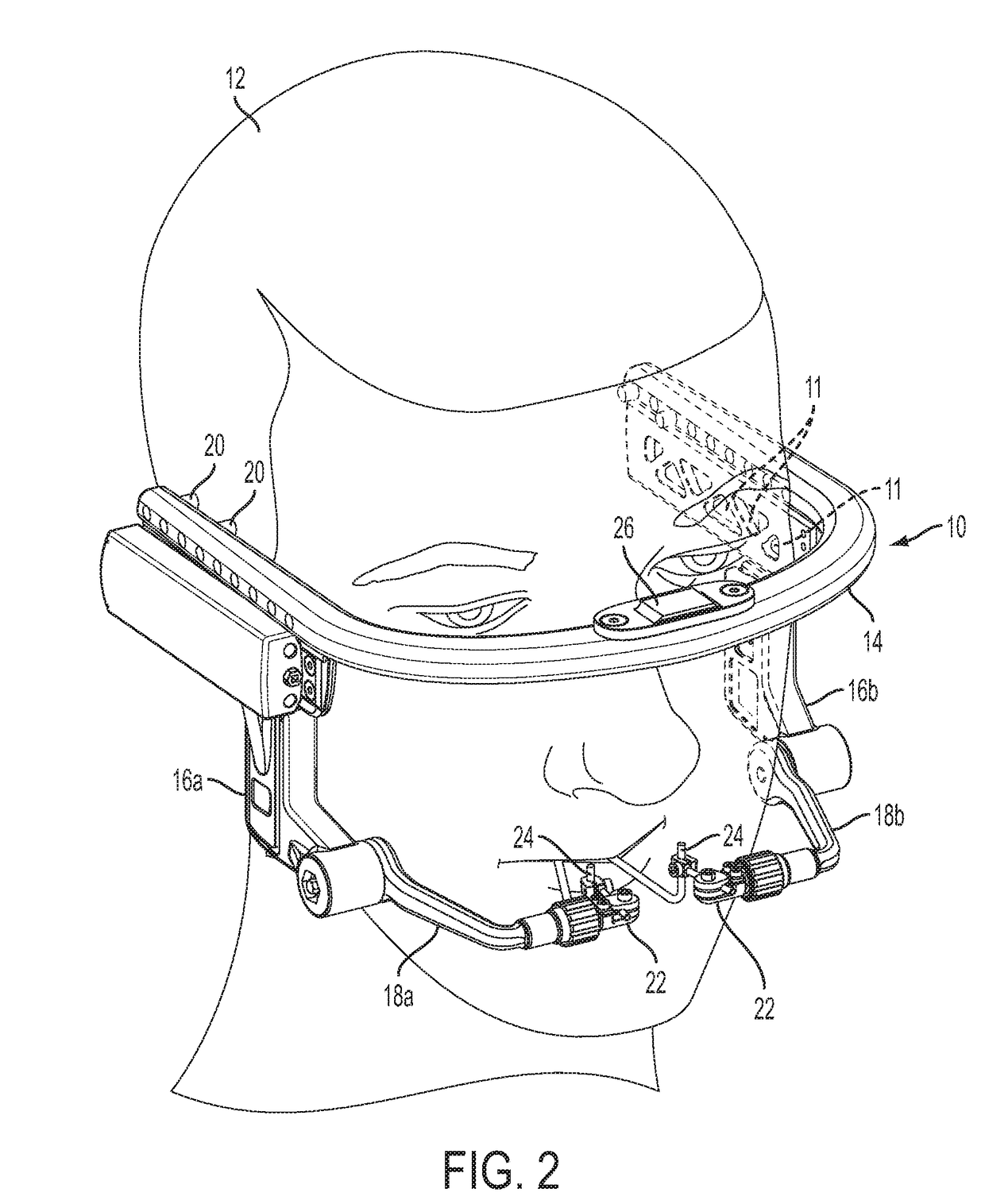 Craniofacial External Distraction Apparatus