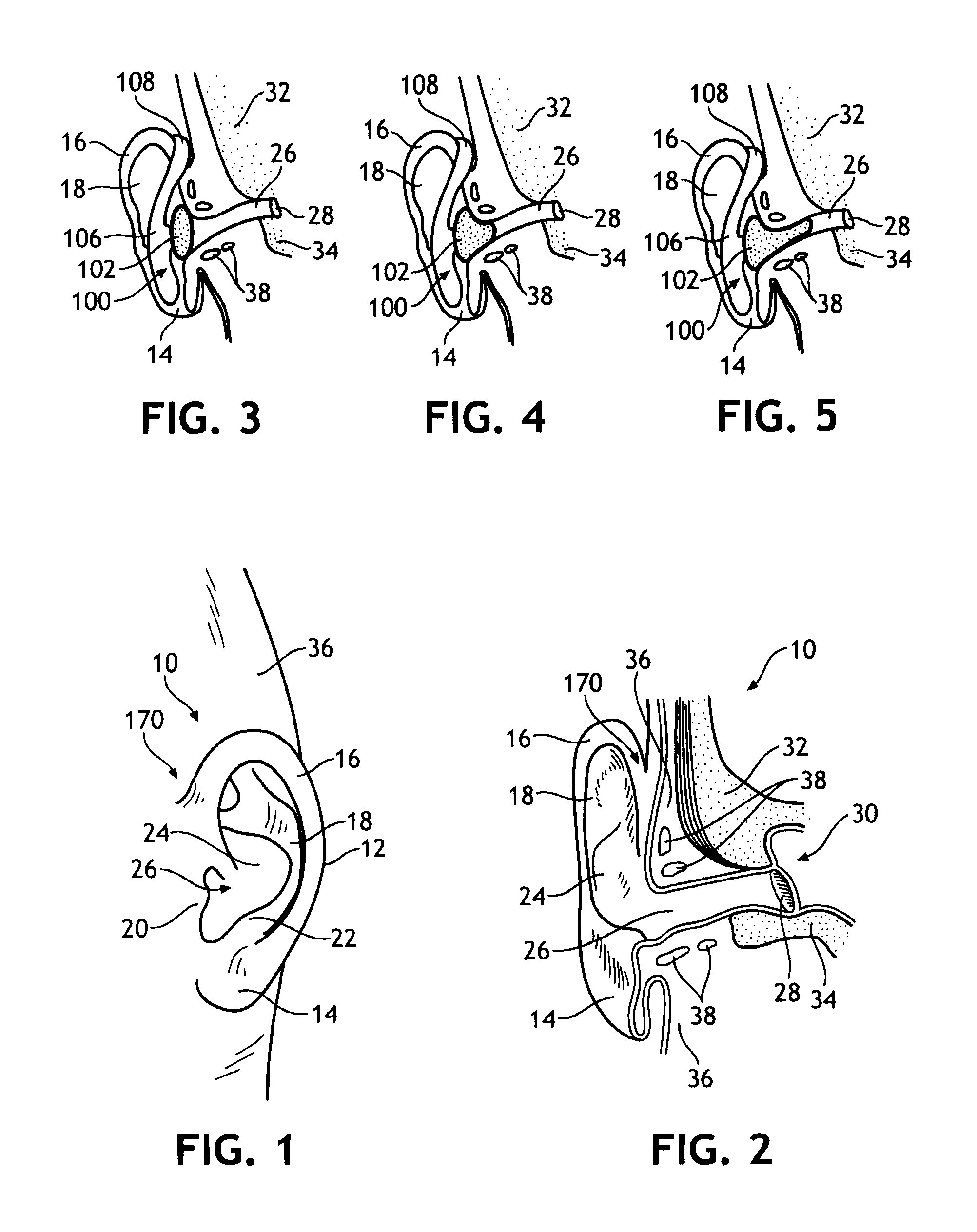 Clip-style hearing protector