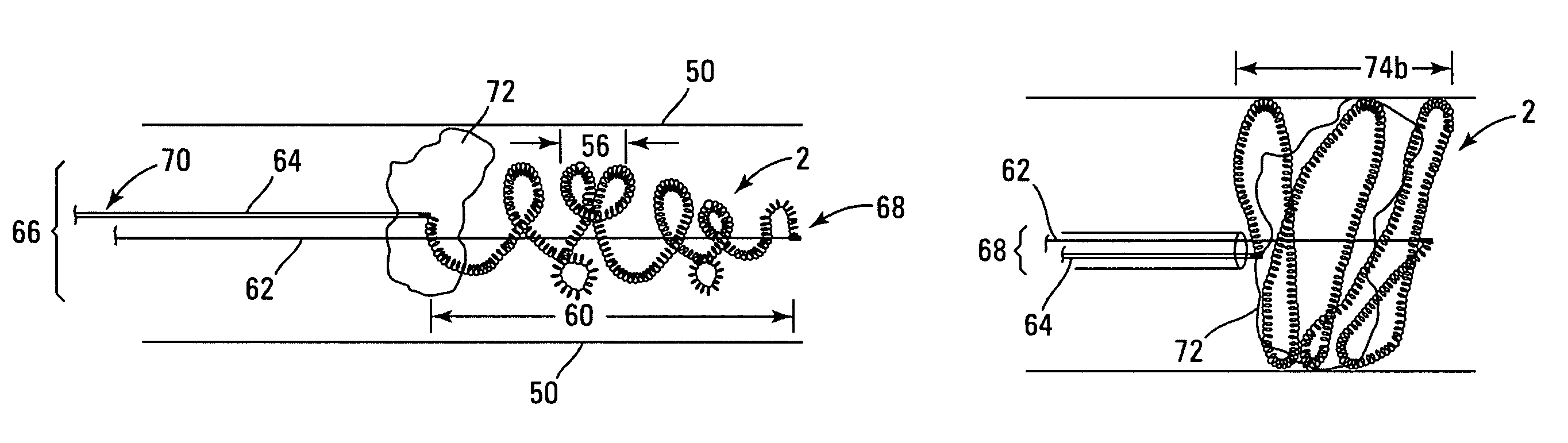 Thrombus removal system and process