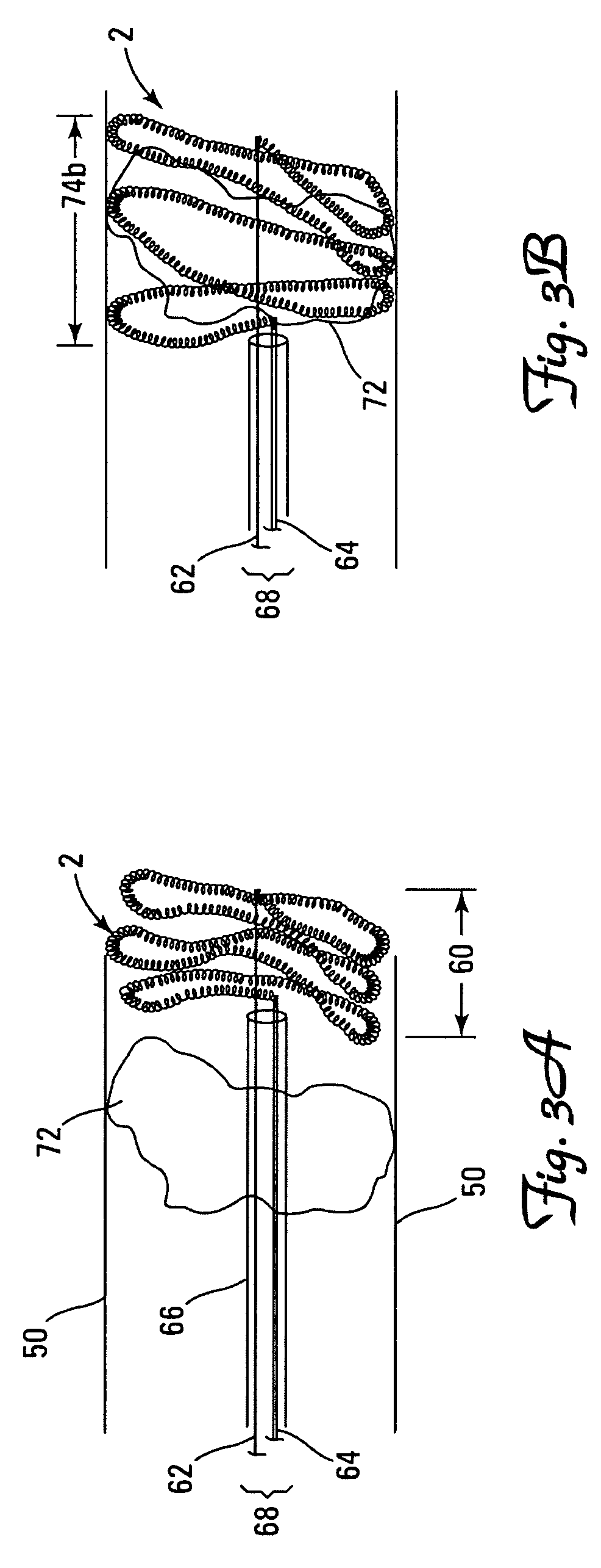 Thrombus removal system and process