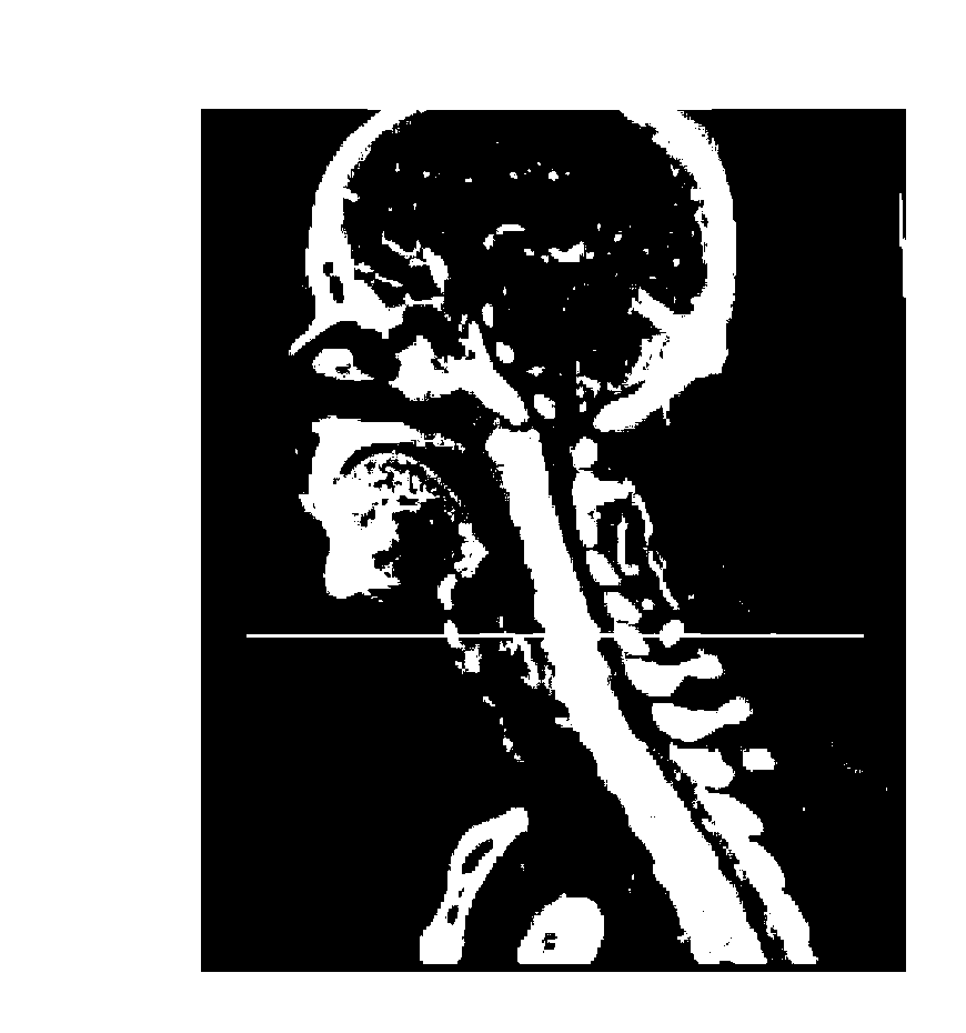 Head and neck CTA (computed tomography angiography) image layering method and device