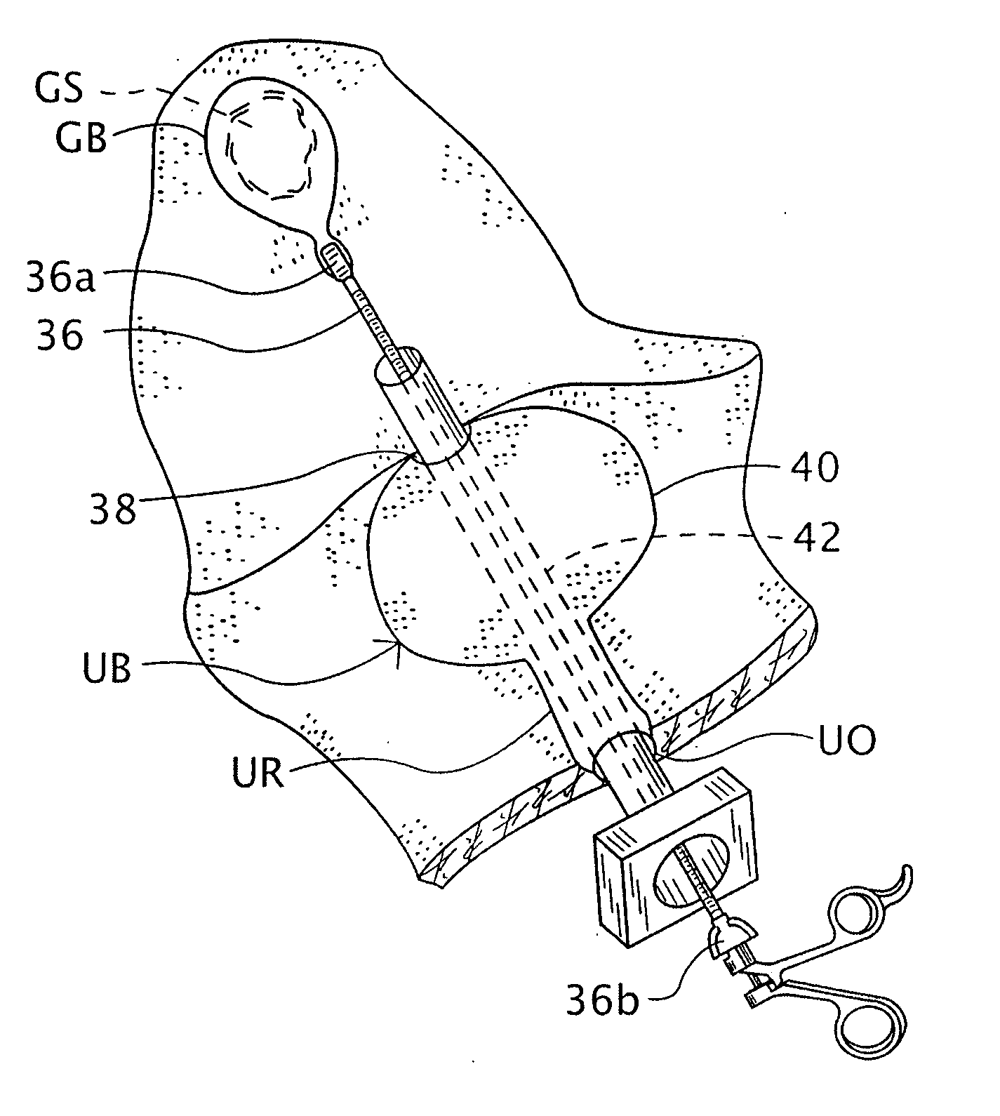 Intra-abdominal medical procedures and device