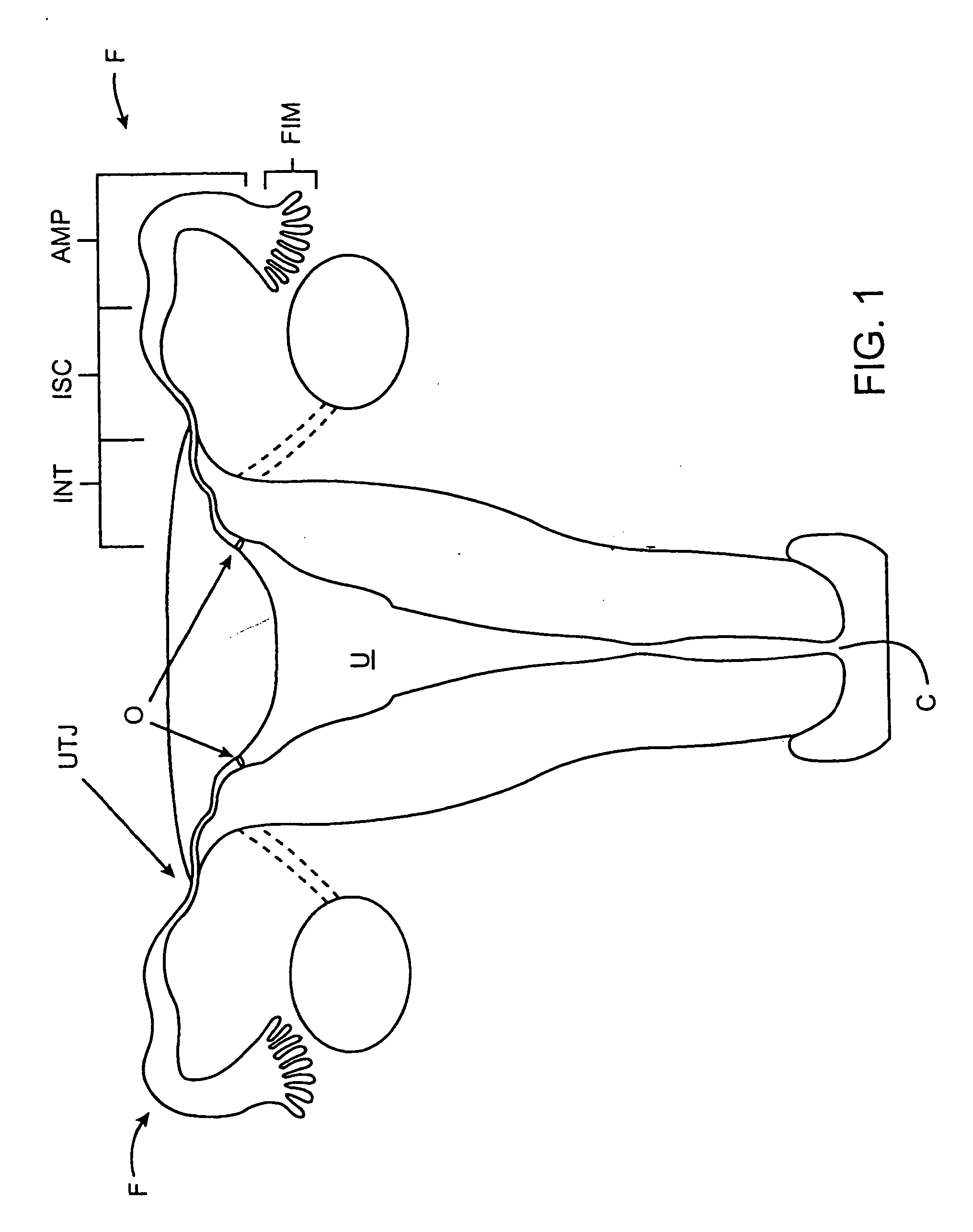 Deployment actuation system for intrafallopian contraception