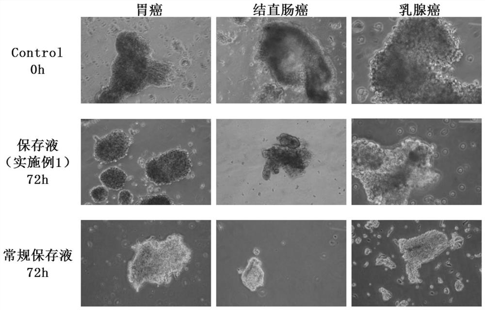 Tumor tissue preserving fluid and application