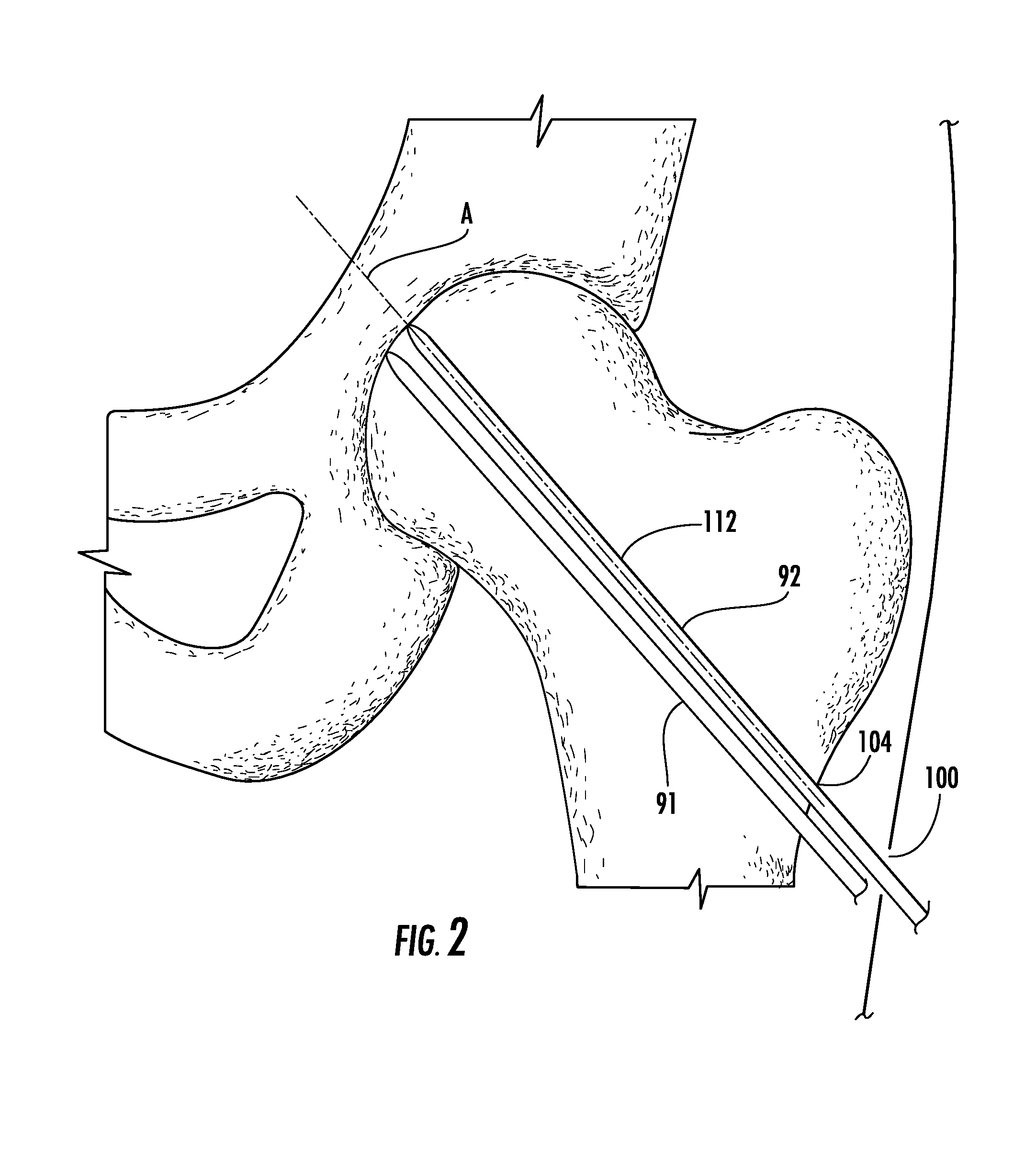 Guide Pin Placement for Hip Resurfacing