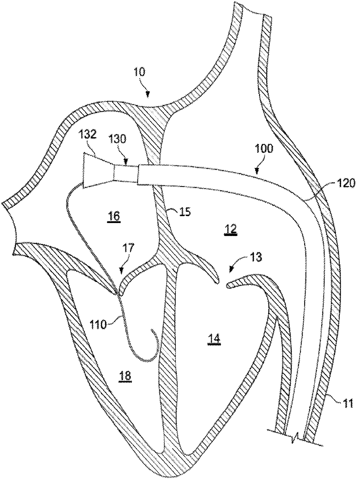 Systems and methods for heart valve therapy