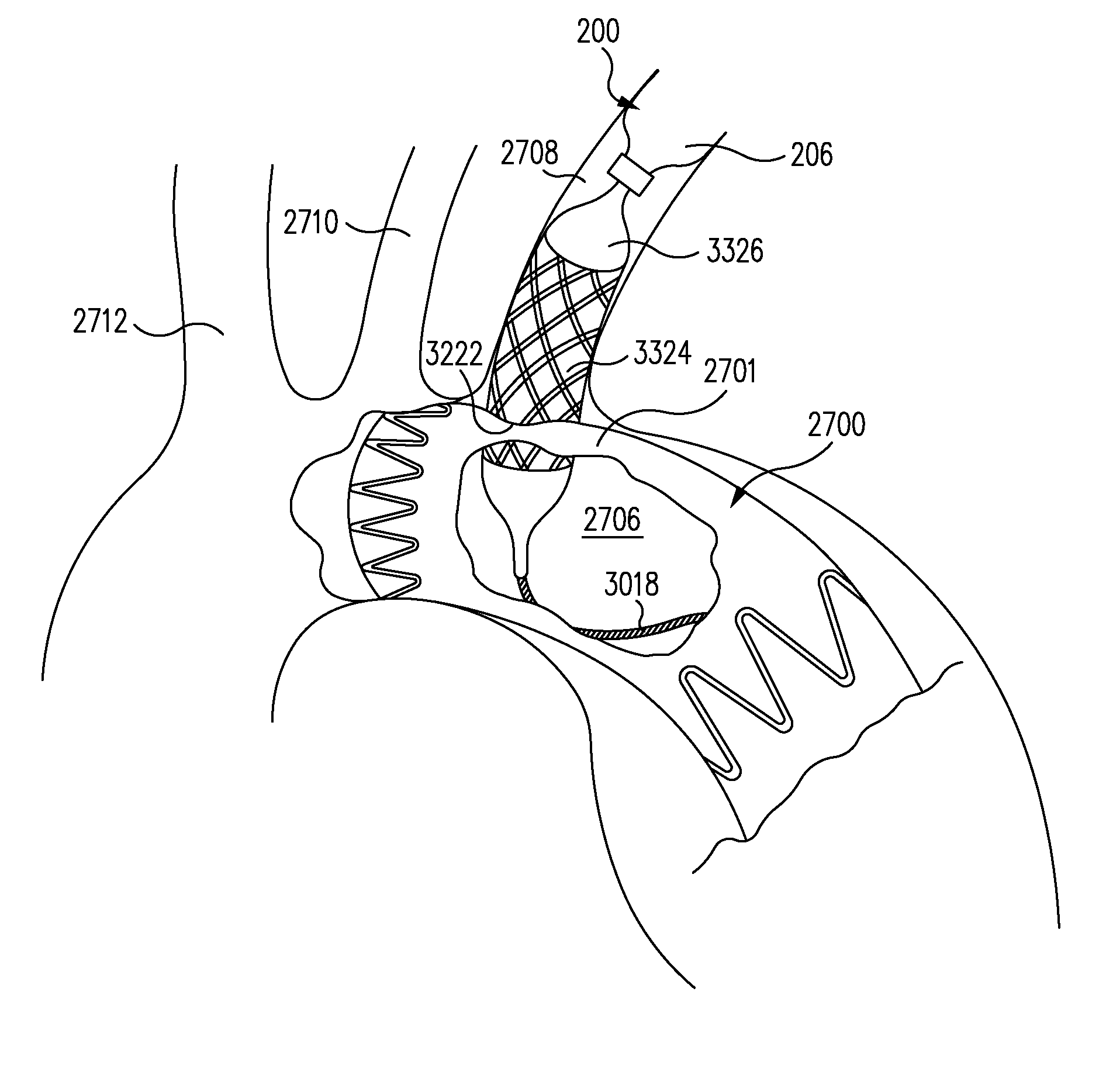 Device and Method for Stent Graft Fenestration in Situ