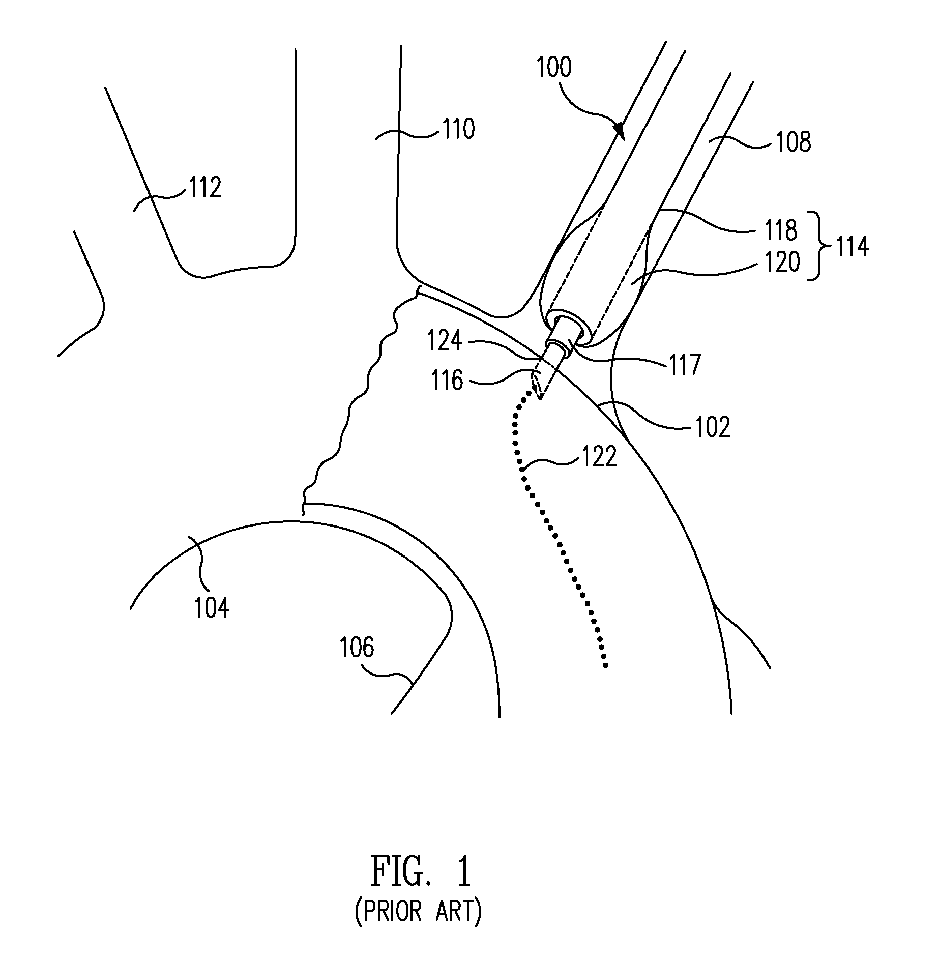 Device and Method for Stent Graft Fenestration in Situ