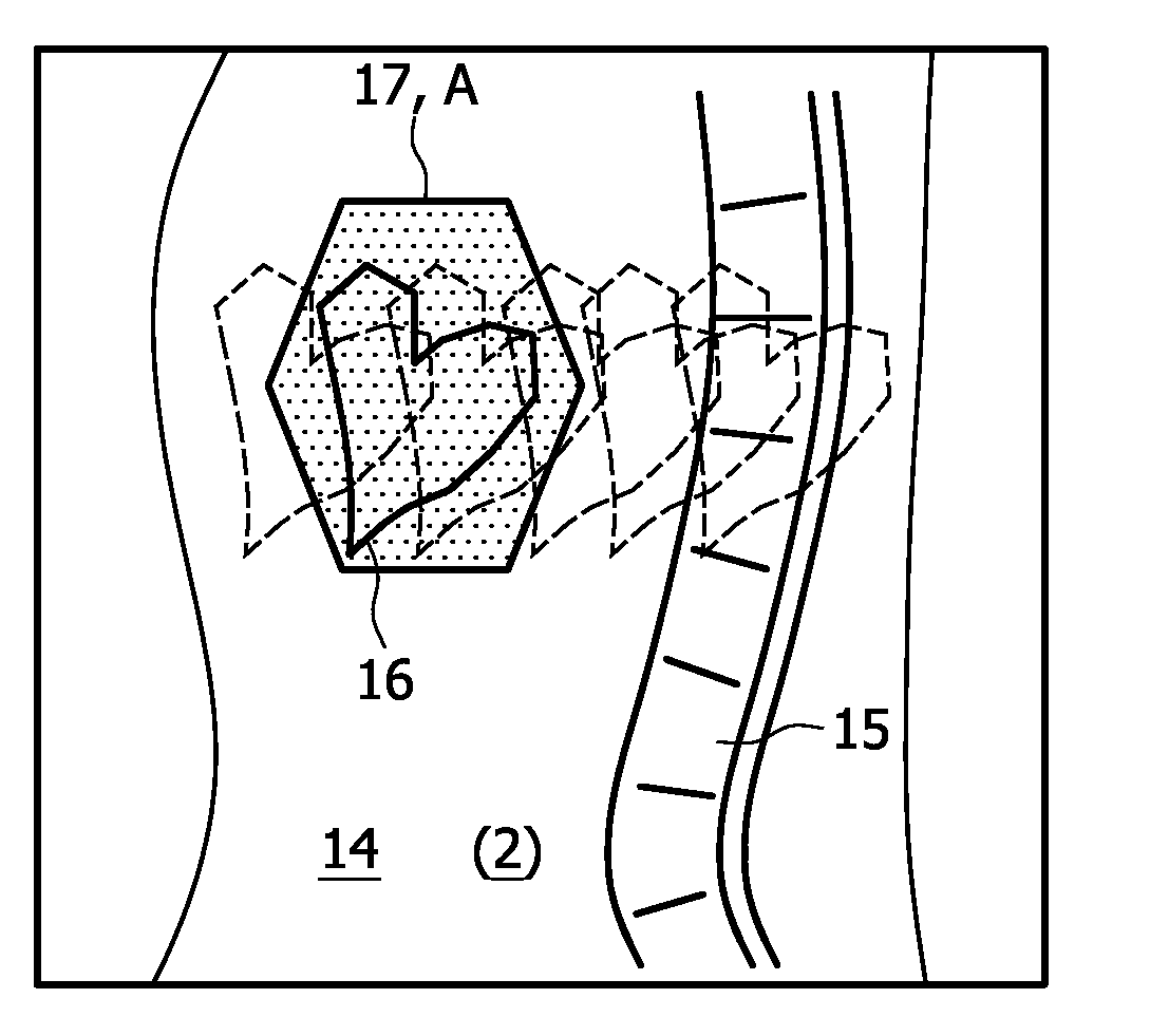 Artifact suppression in multi-coil MRI