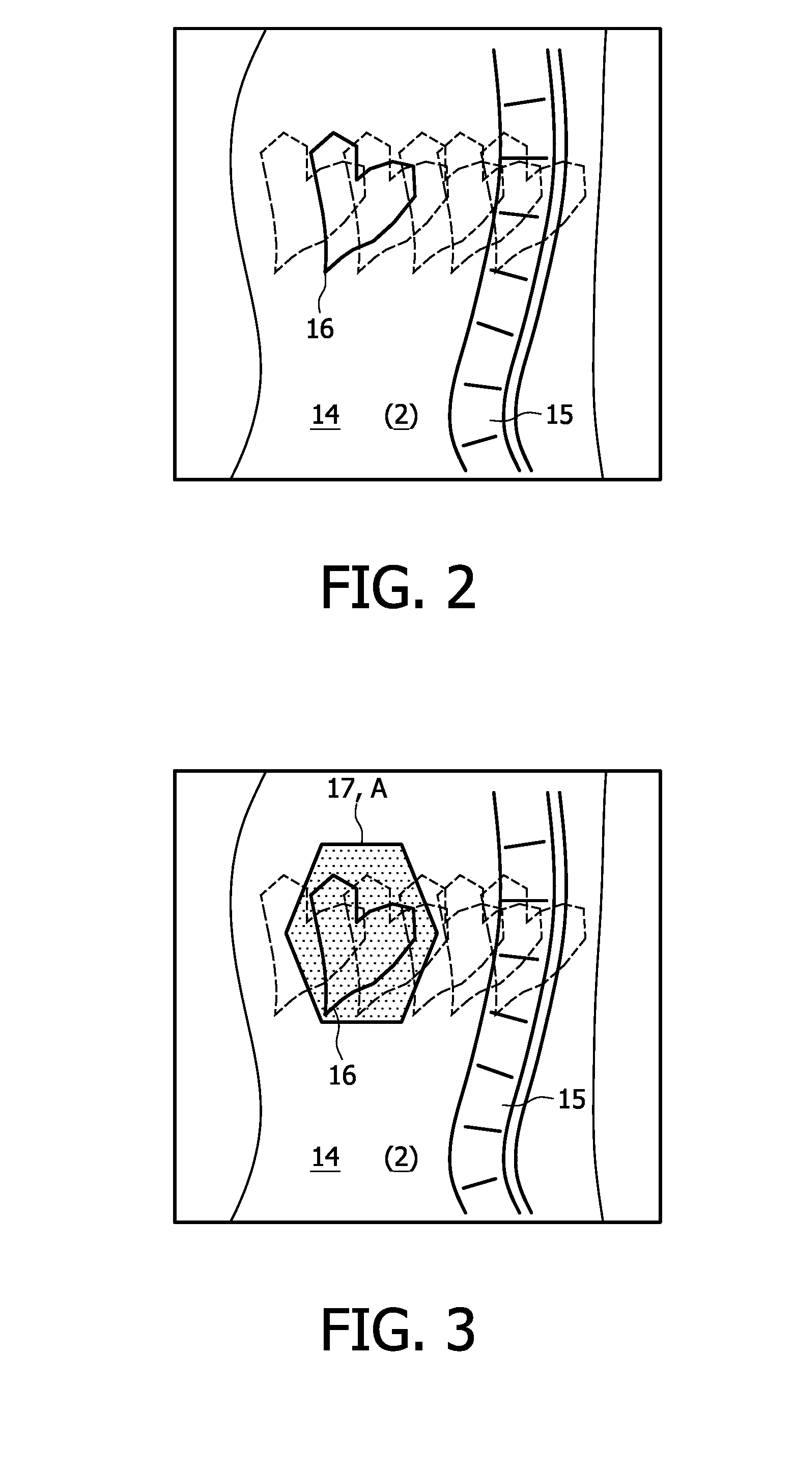 Artifact suppression in multi-coil MRI