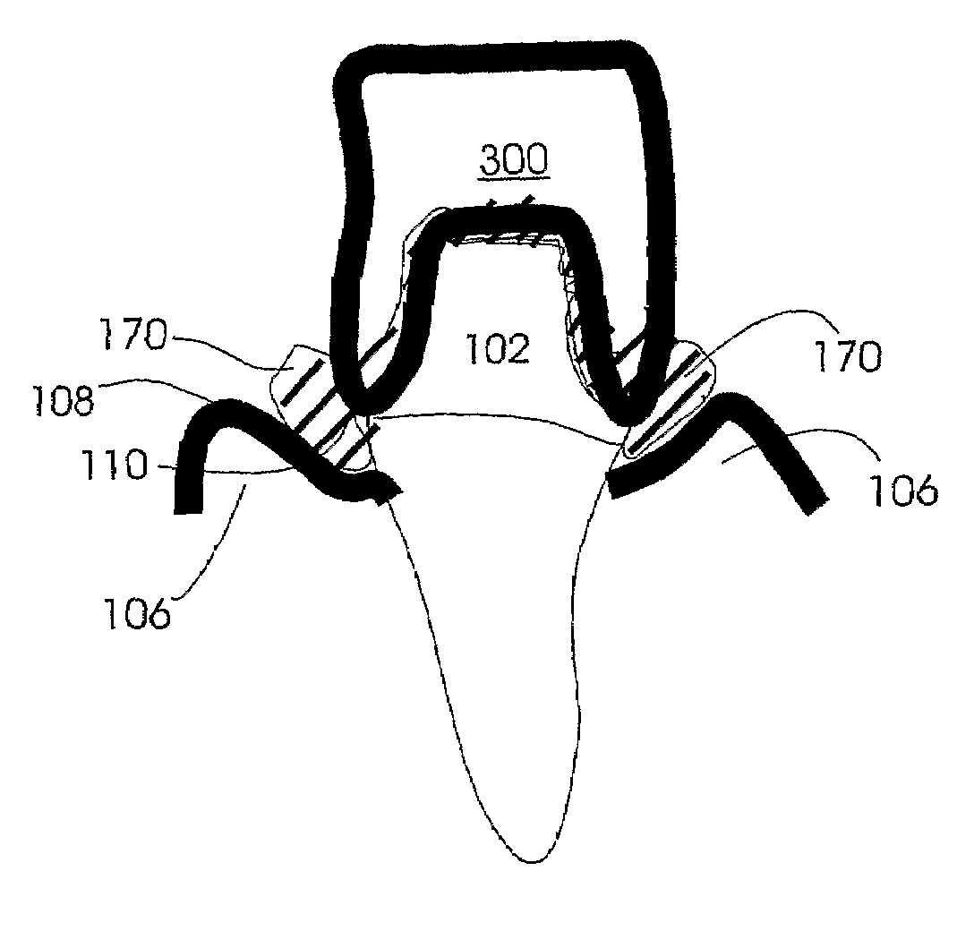 Custom impression coping and methods of manufacture and use thereof