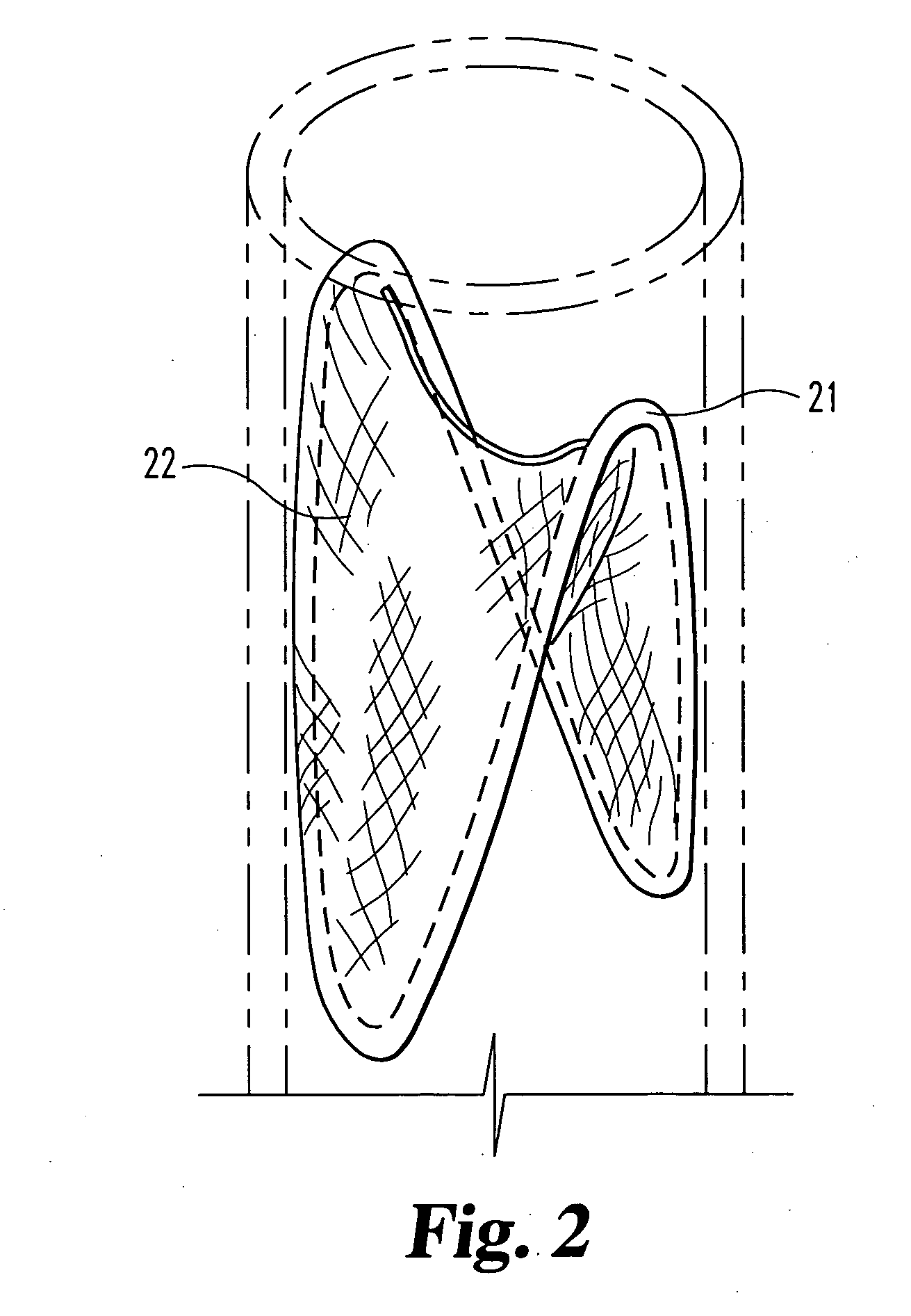 Graft prosthesis devices containing renal capsule collagen