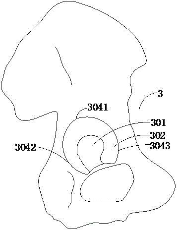 Fabrication template system for custom individual artificial total hip replacement operation acetabulum