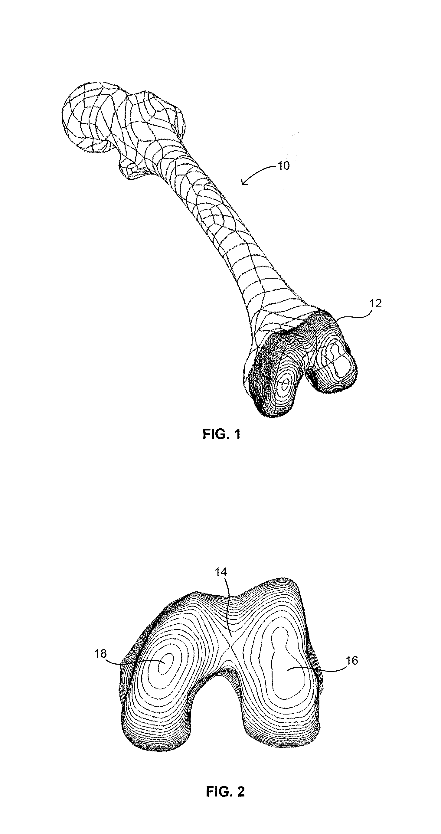 Extended patellofemoral