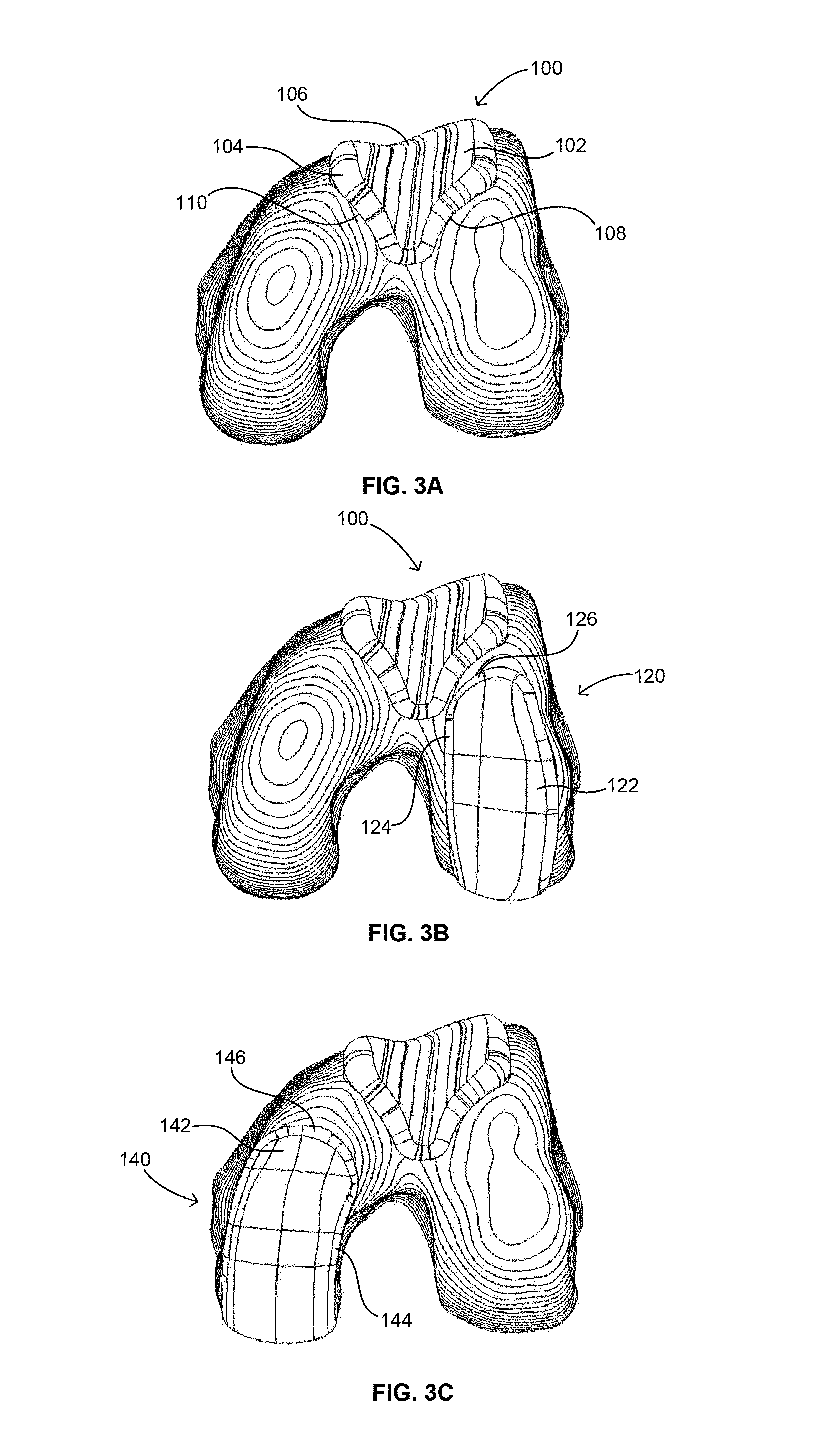 Extended patellofemoral