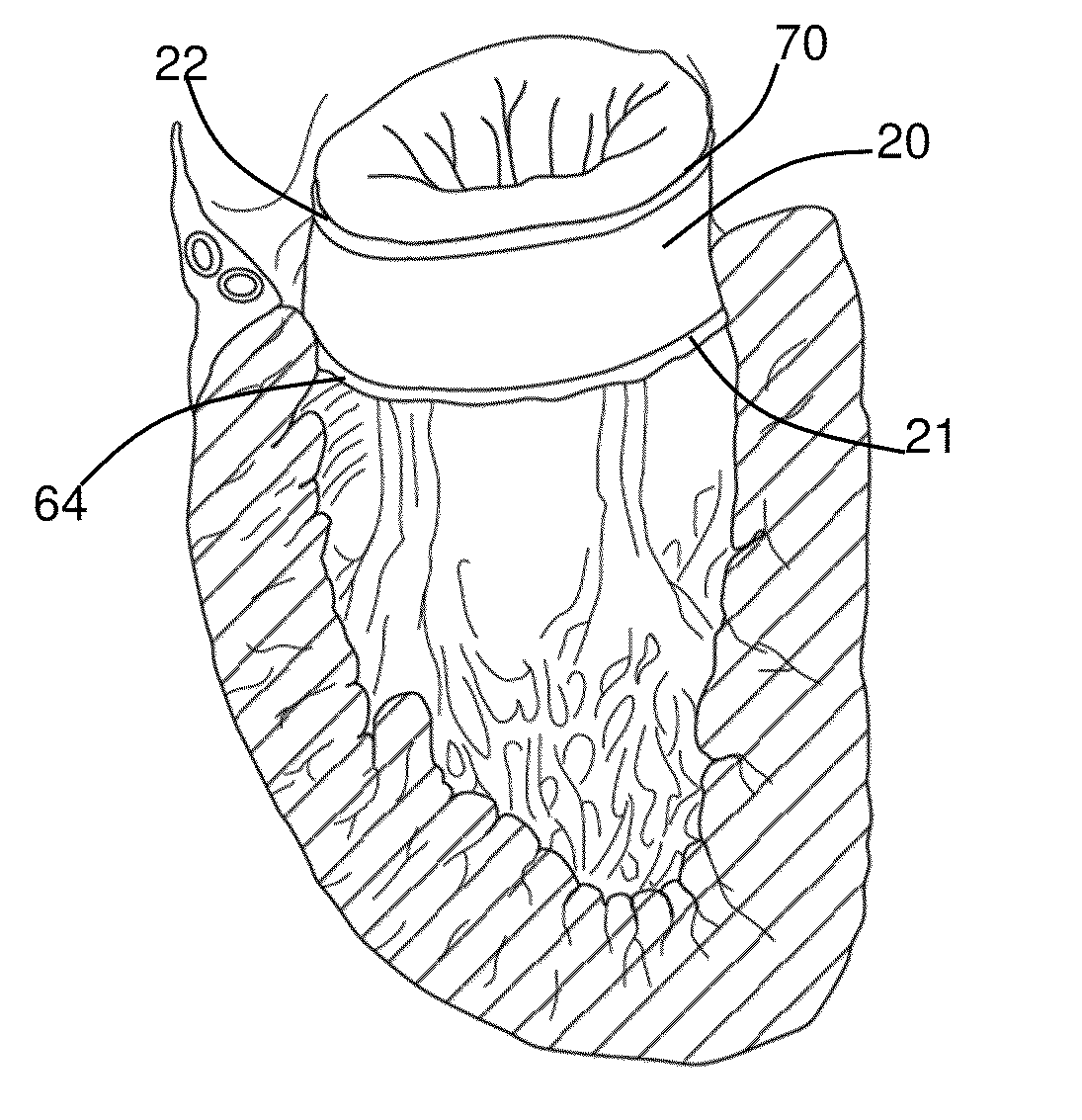 Annuloplasty tubes