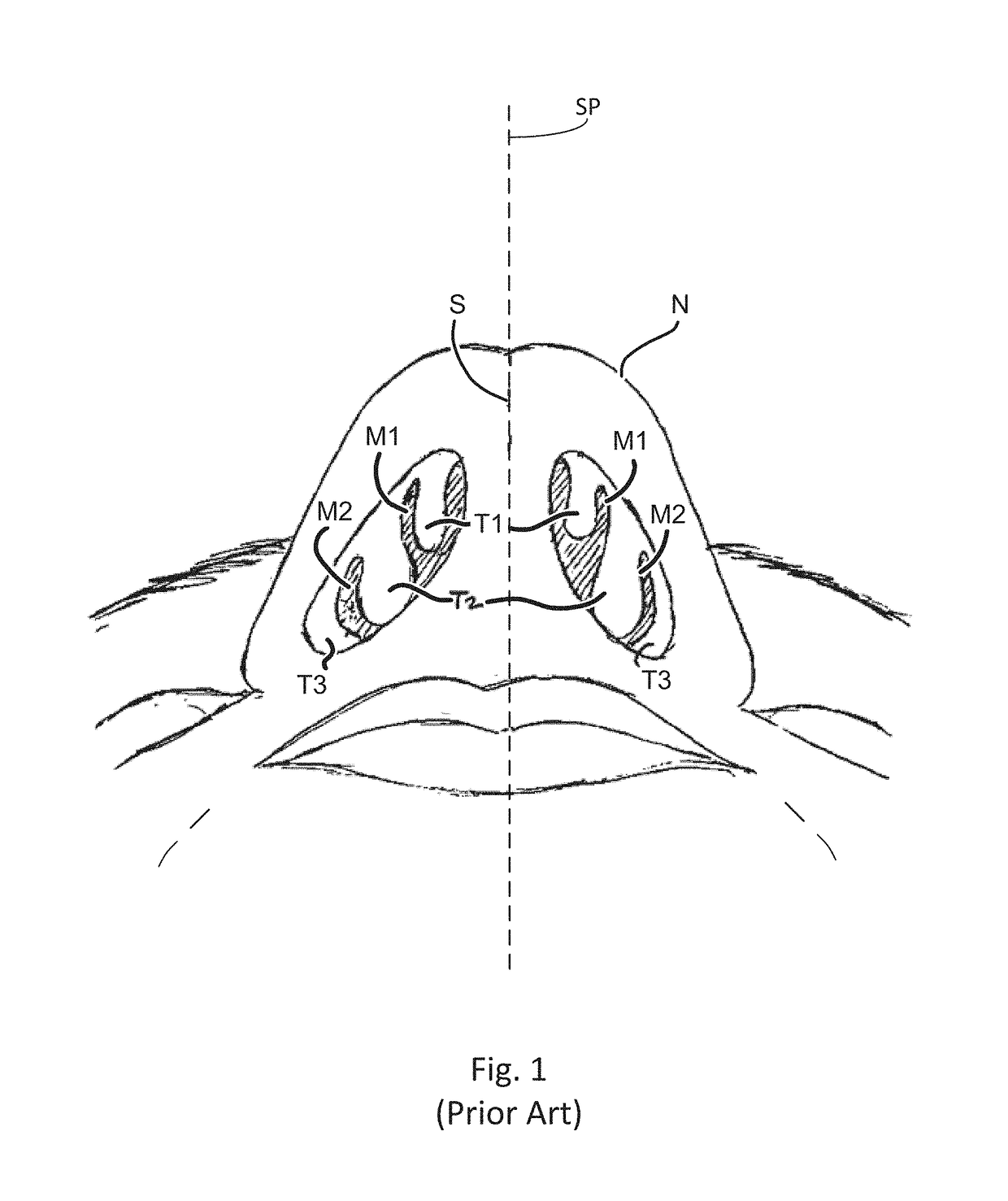 Devices and methods for treating a lateral surface of a nasal cavity